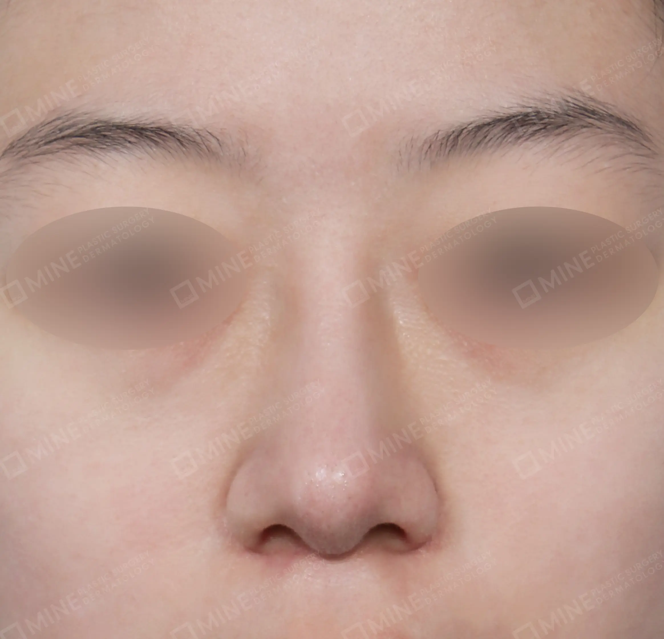 Nâng sống mũi + thu gọn đầu mũi + cắt cánh mũi-정면-후