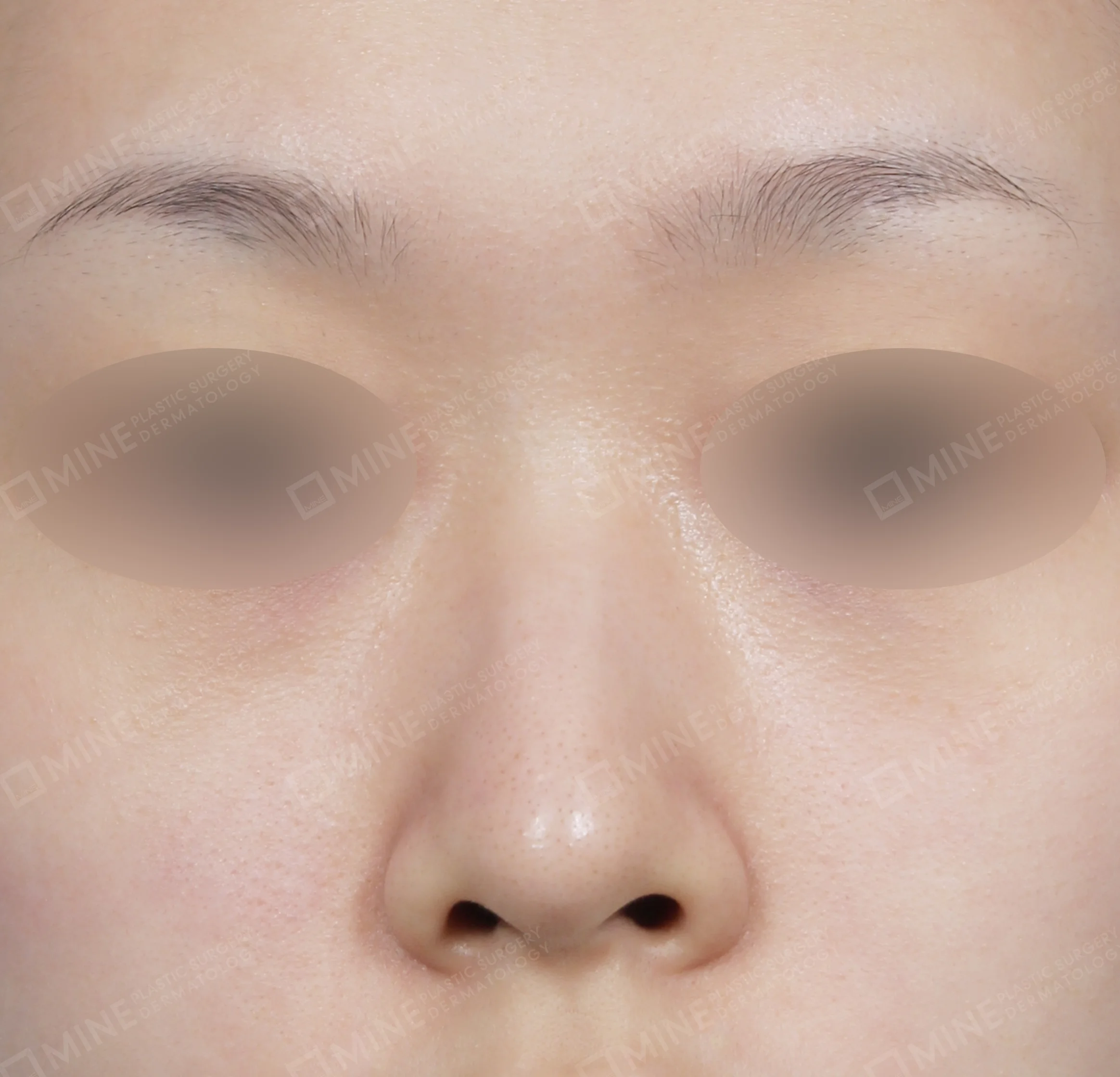 Nâng sống mũi + kéo dài đầu mũi + mài gồ-정면-전