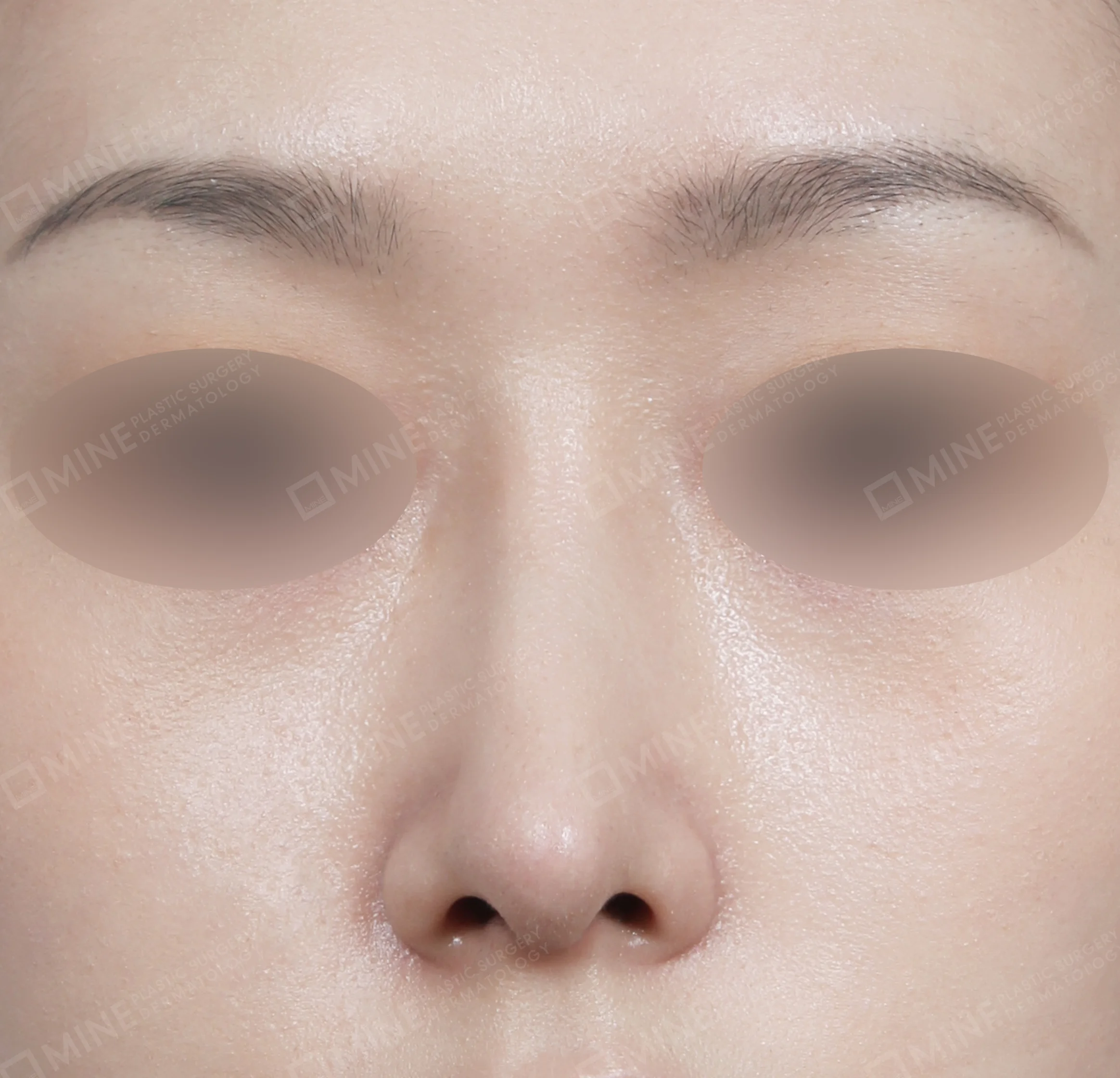 Nâng sống mũi + kéo dài đầu mũi + mài gồ-정면-후