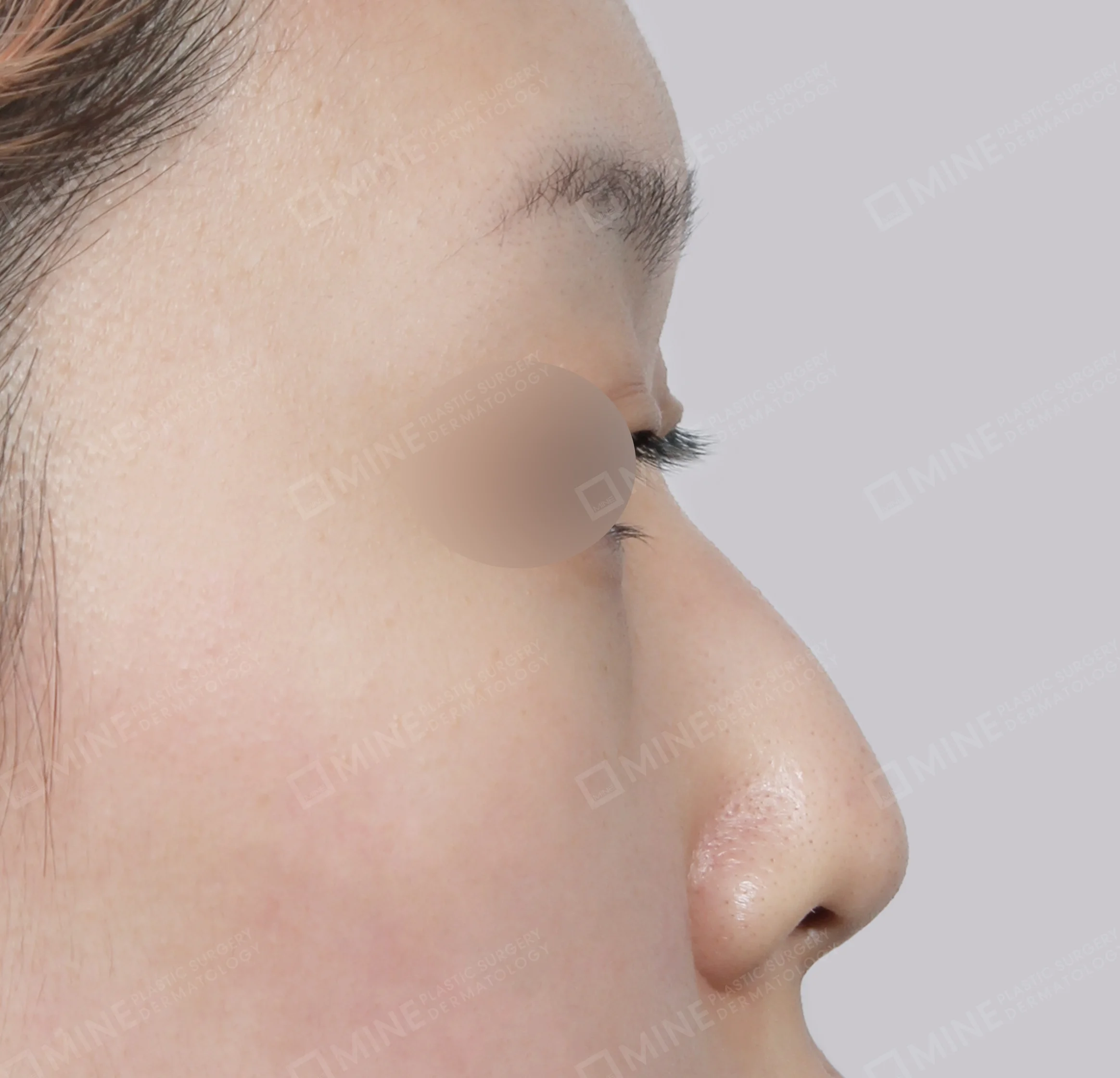 Nâng sống mũi + kéo dài đầu mũi + mài gồ-측면-전