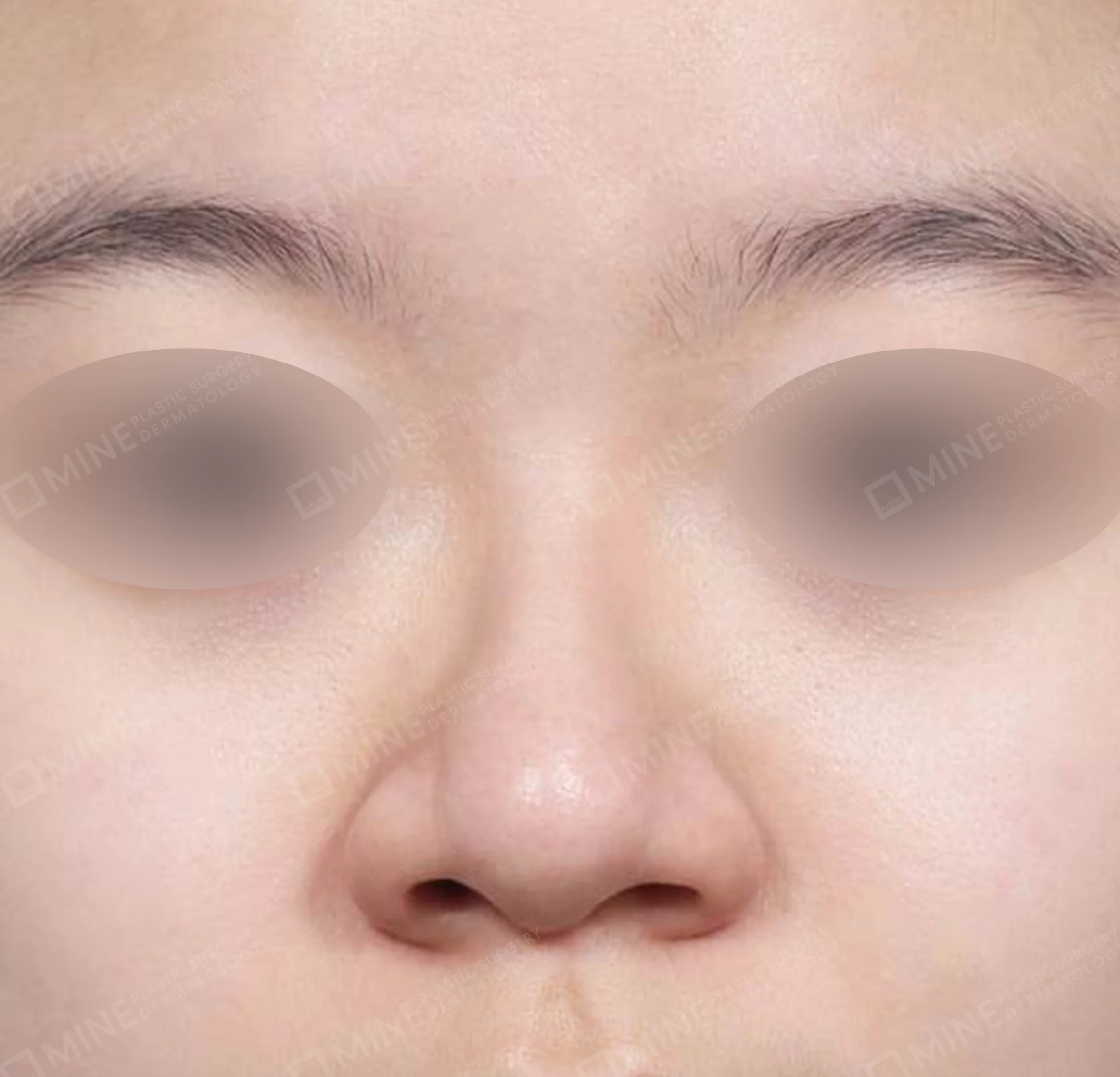 Nâng sống mũi + mài gồ + gom xương + thu gọn cánh mũi-정면-전