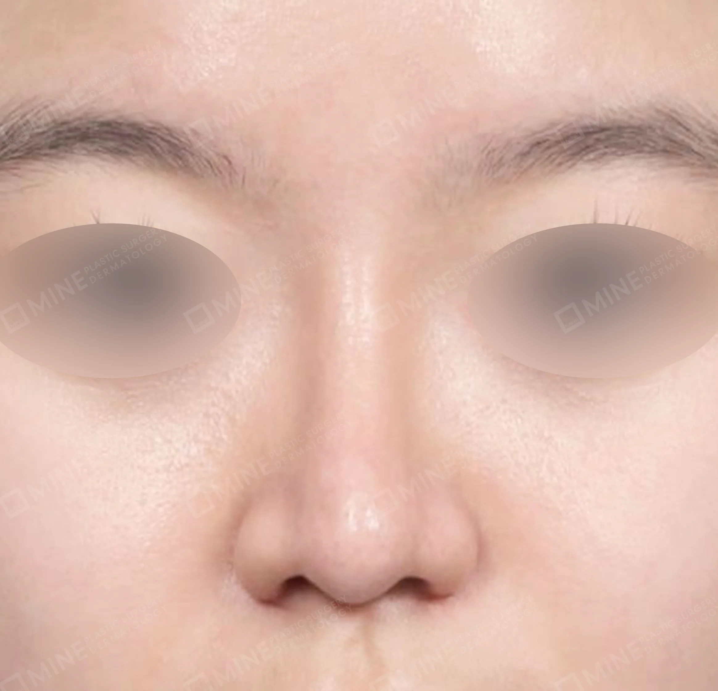 Nâng sống mũi + mài gồ + gom xương + thu gọn cánh mũi-정면-후