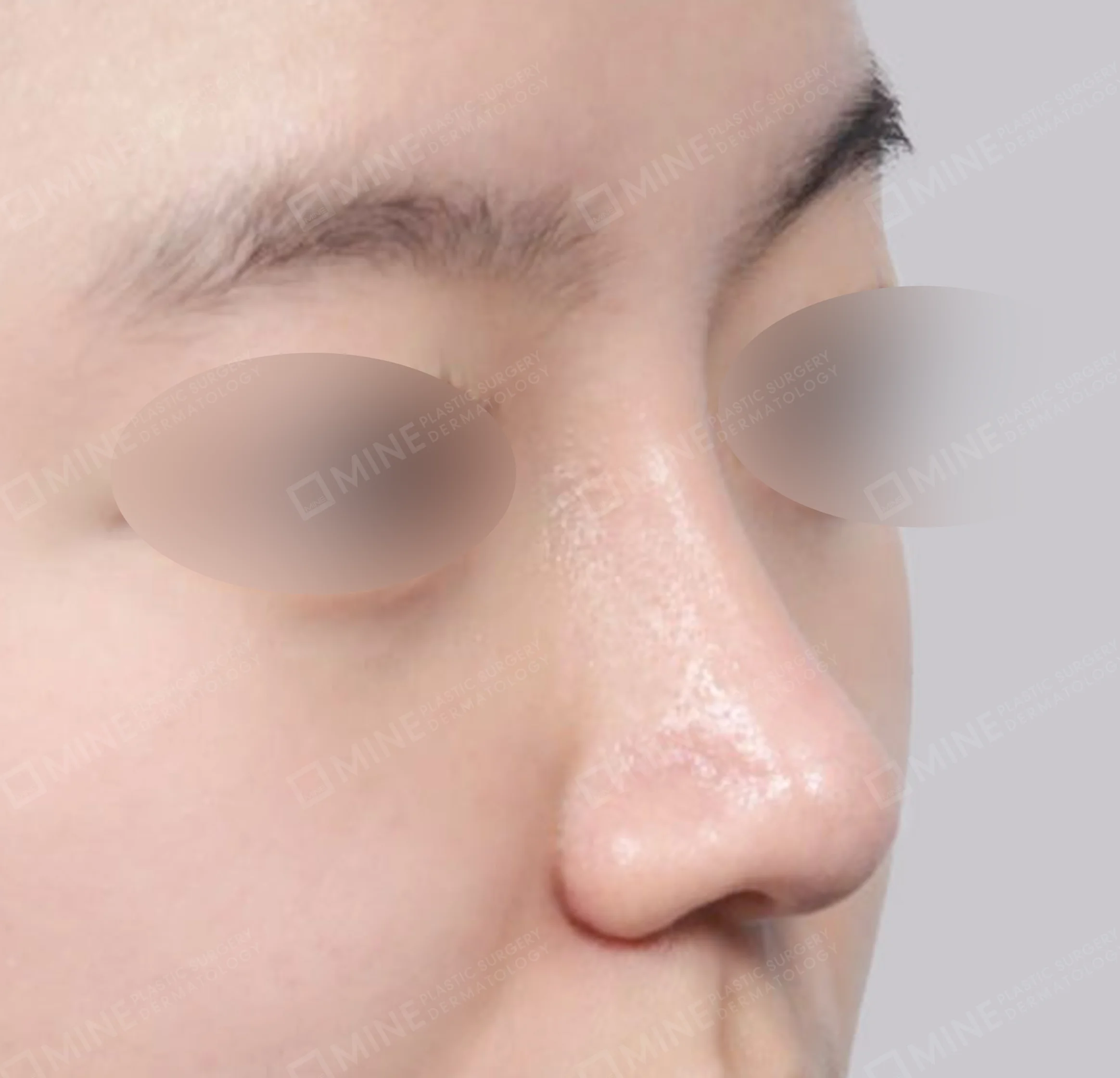 Nâng sống mũi + mài gồ + gom xương + thu gọn cánh mũi-측면-후