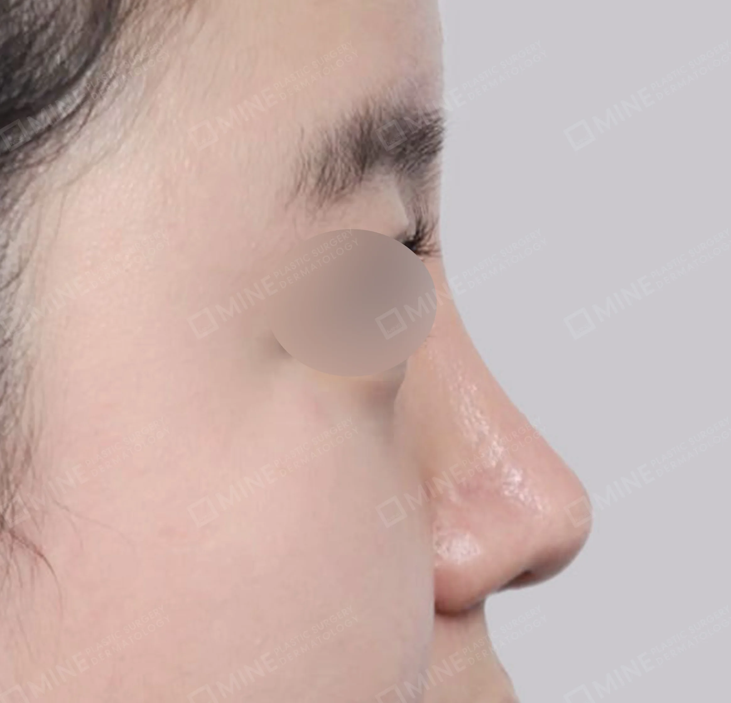 Nâng sống mũi + mài gồ + gom xương + thu gọn cánh mũi-45도-후