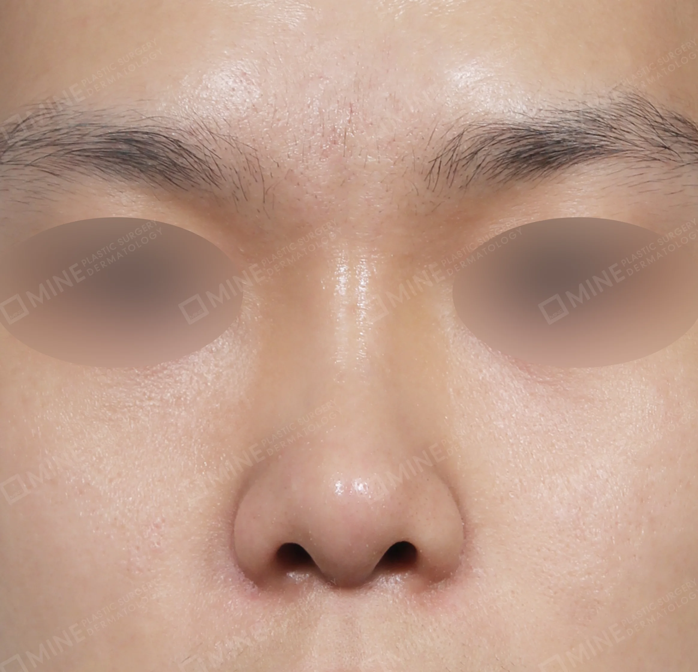 Nâng sống mũi + kéo dài đầu mũi + mài gồ + thu gọn đầu mũi-정면-후