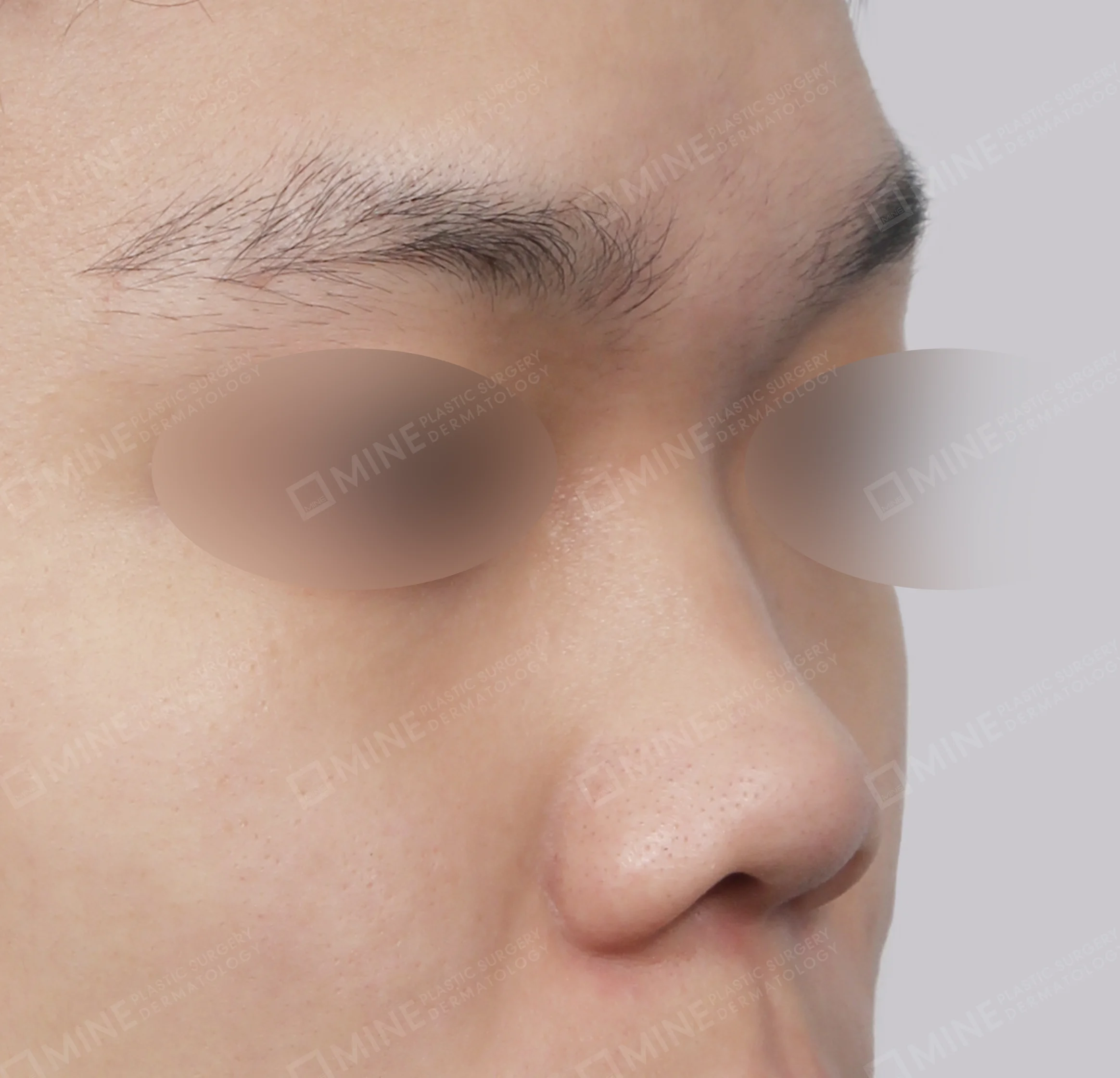 Nâng sống mũi + kéo dài đầu mũi + mài gồ + thu gọn đầu mũi-45도-전