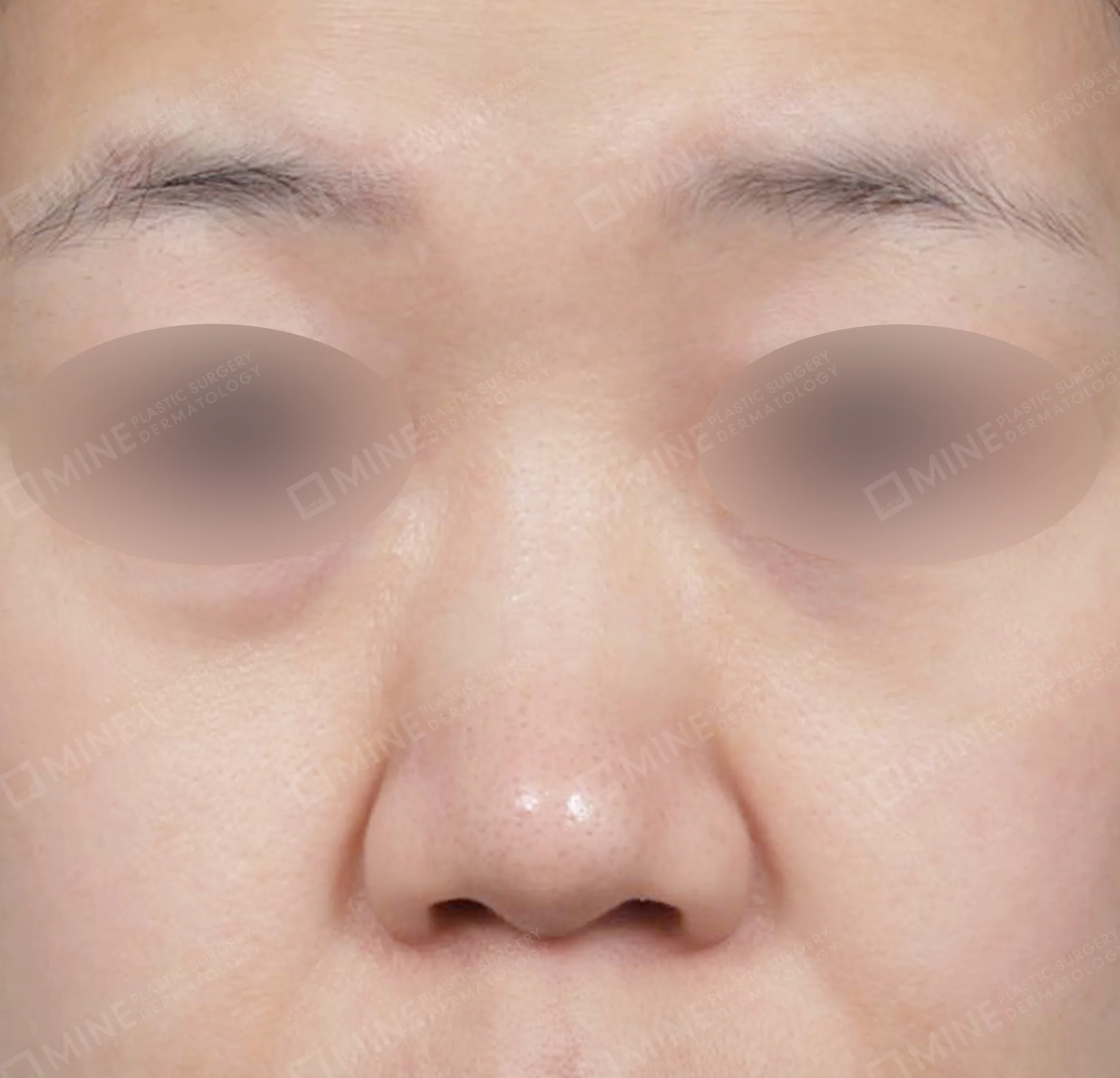 Nâng sống mũi + thu nhỏ đầu mũi + kéo dài đầu mũi + cắt cánh mũi-정면-전