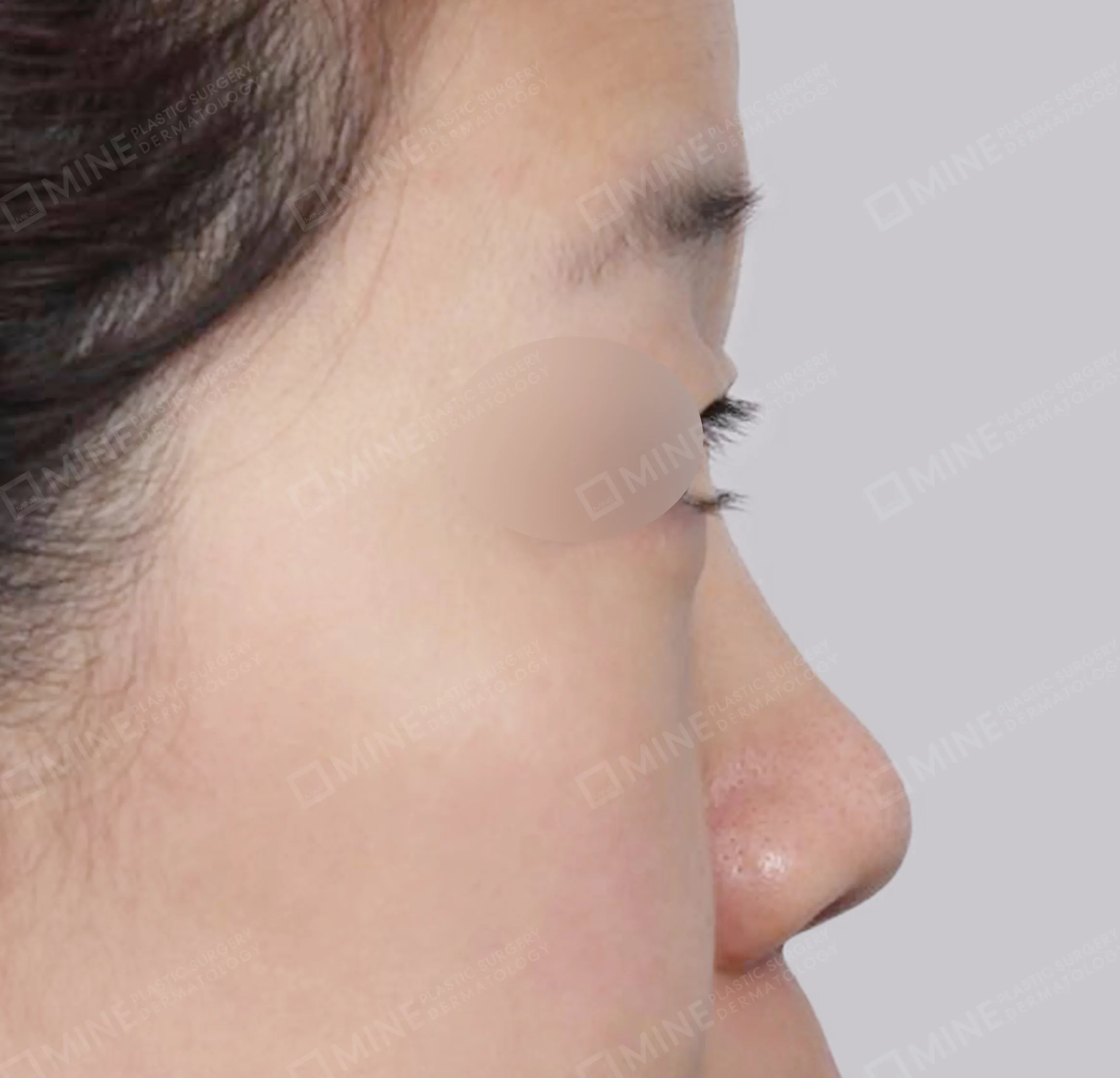 Nâng sống mũi + thu nhỏ đầu mũi + kéo dài đầu mũi + cắt cánh mũi-측면-전