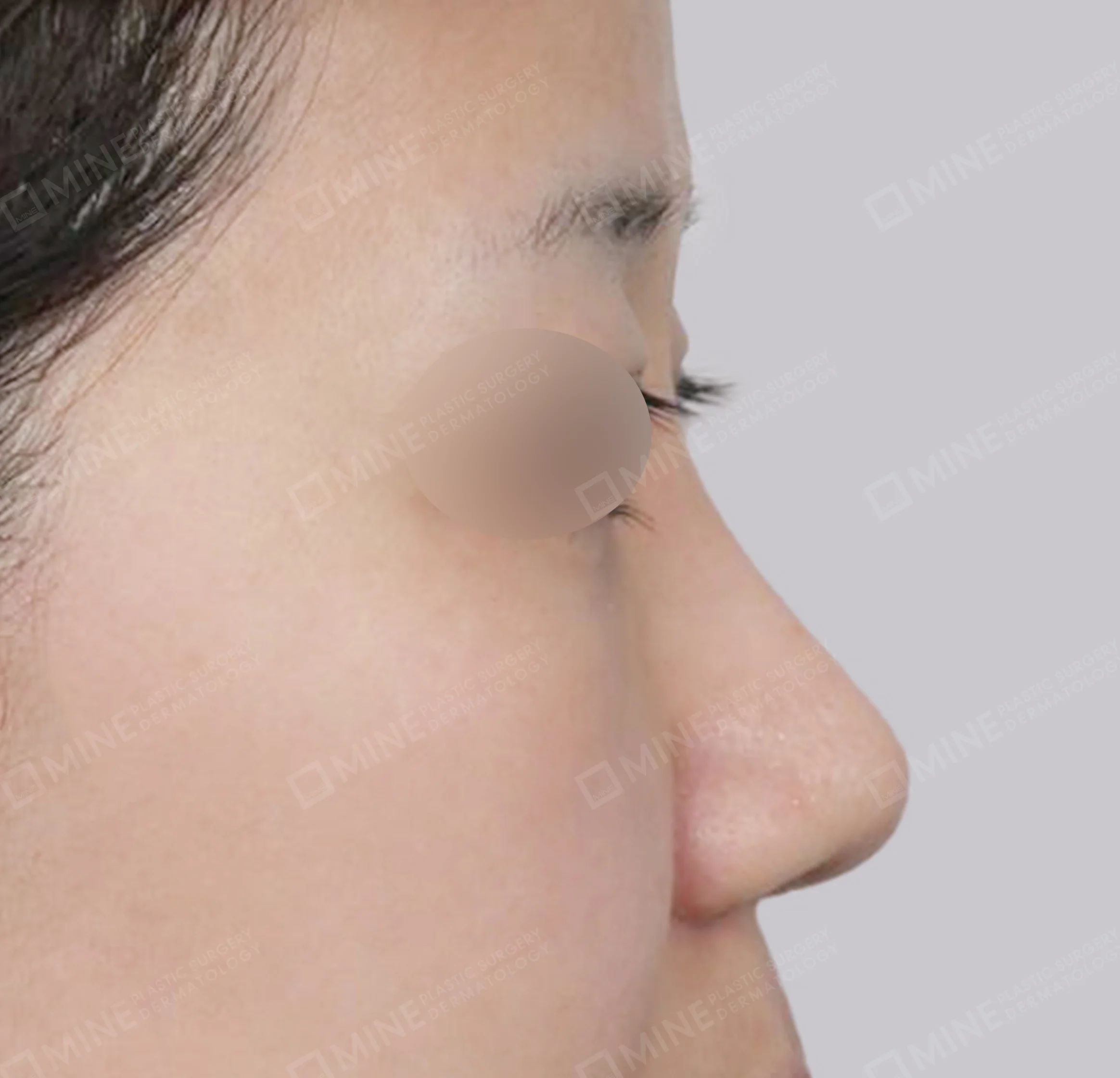 Nâng sống mũi + thu nhỏ đầu mũi + kéo dài đầu mũi + cắt cánh mũi-측면-후