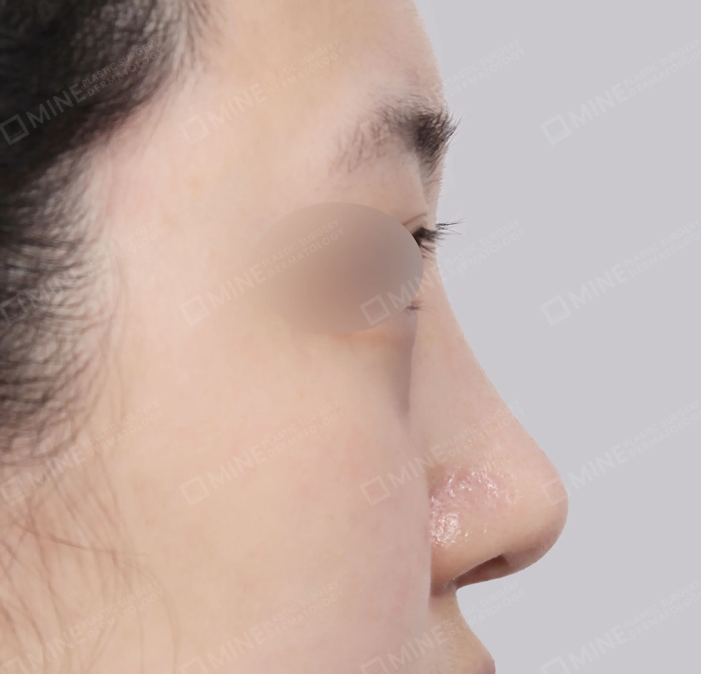 Chỉnh hình mũi lệch + gom xương + đầu mũi-측면-후