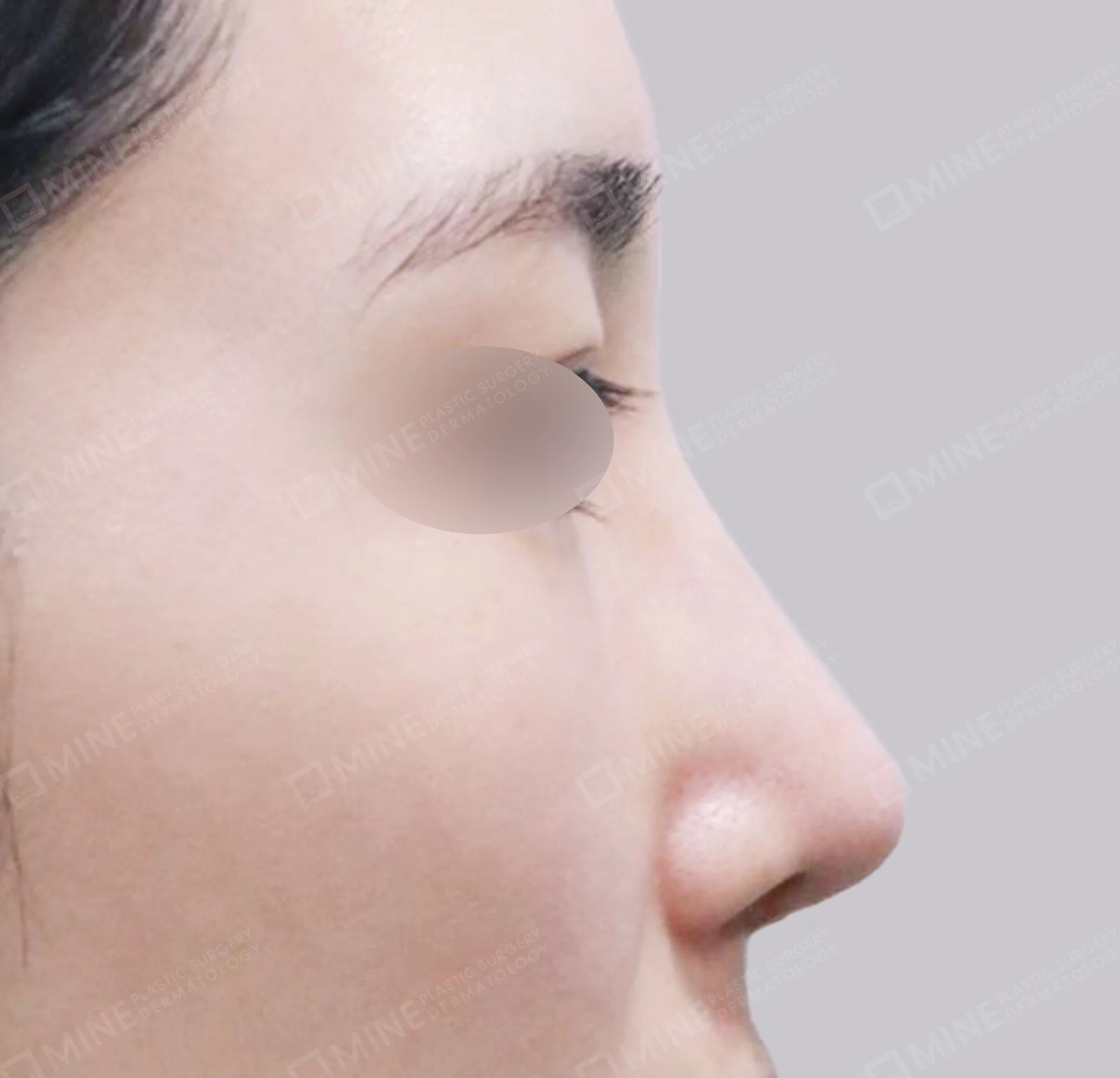 Tái phẫu thuật mũi-측면-후