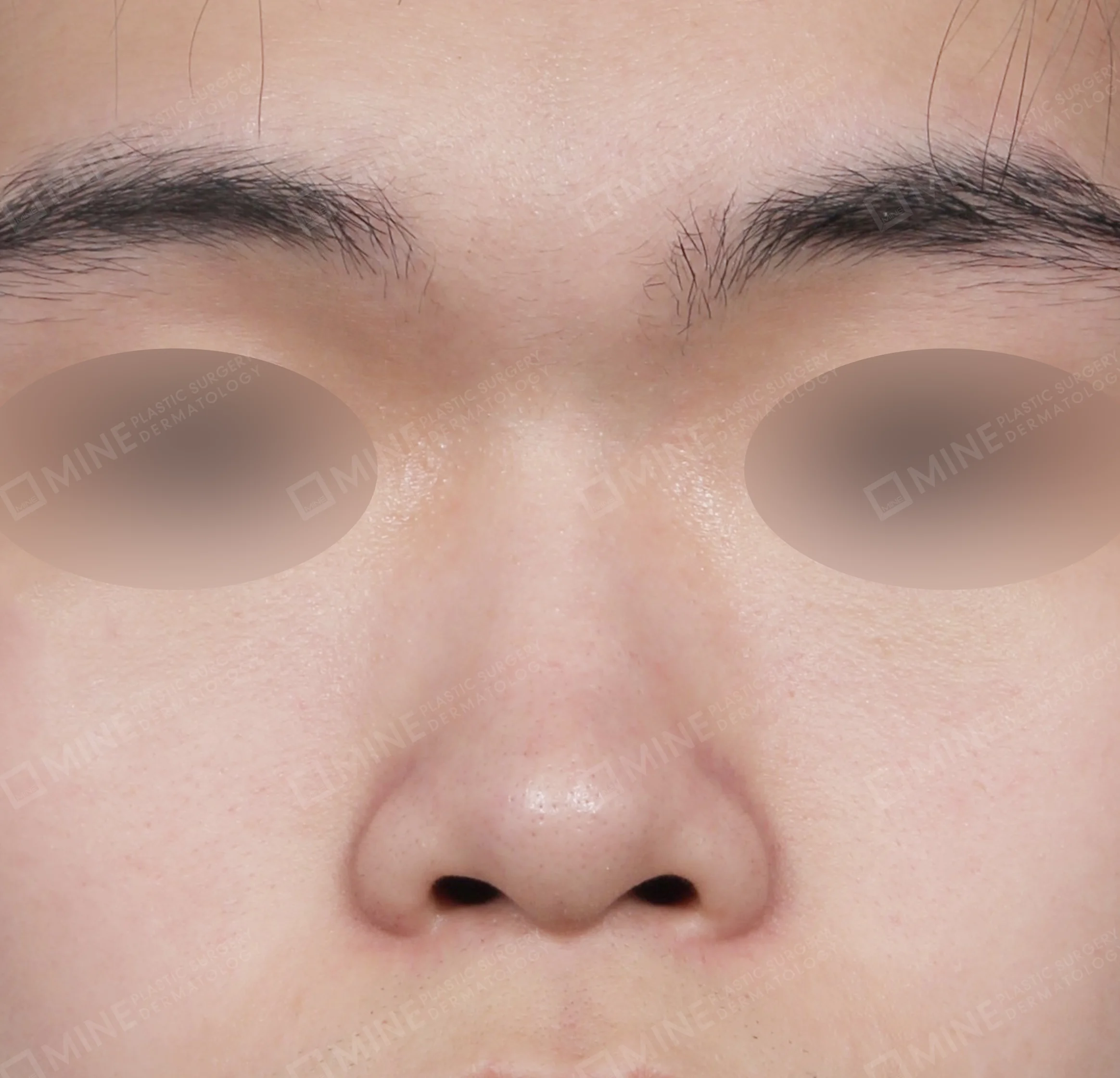 Nâng sống mũi + đầu mũi + kéo dài đầu mũi + thu gọn cánh mũi-정면-전