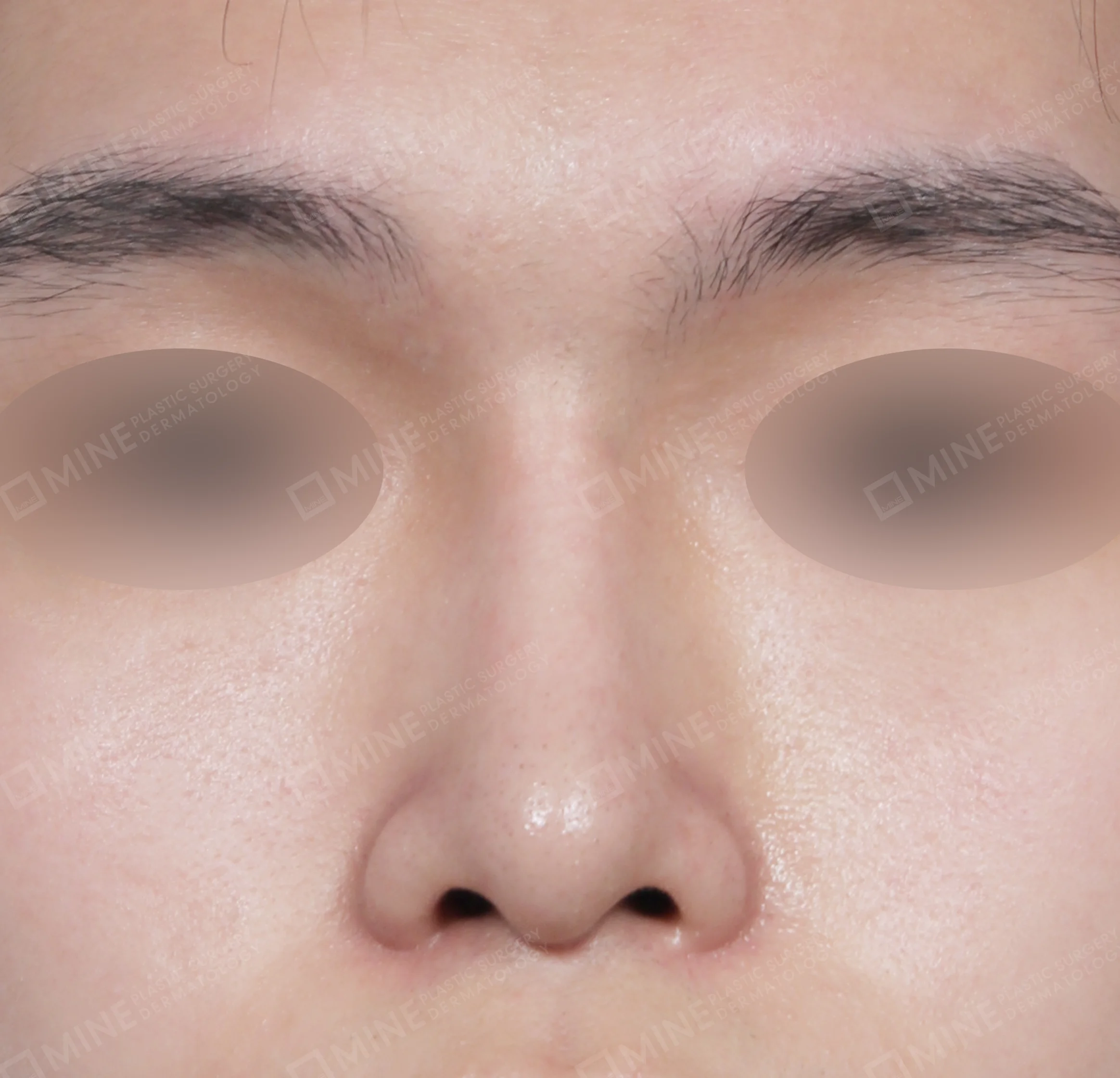 Nâng sống mũi + đầu mũi + kéo dài đầu mũi + thu gọn cánh mũi-정면-후