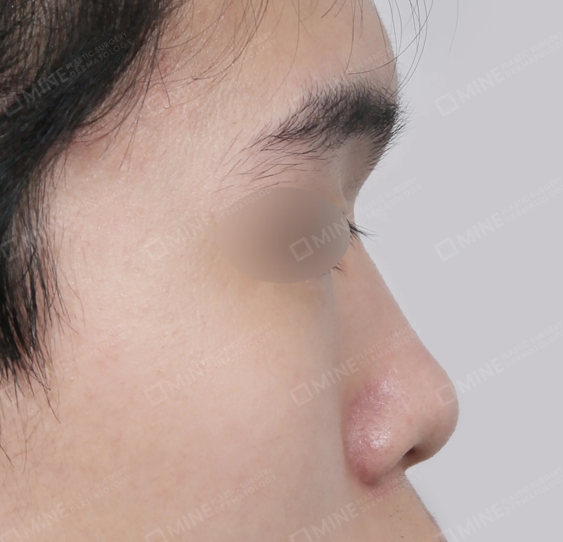 Nâng sống mũi + đầu mũi + kéo dài đầu mũi + thu gọn cánh mũi-측면-전