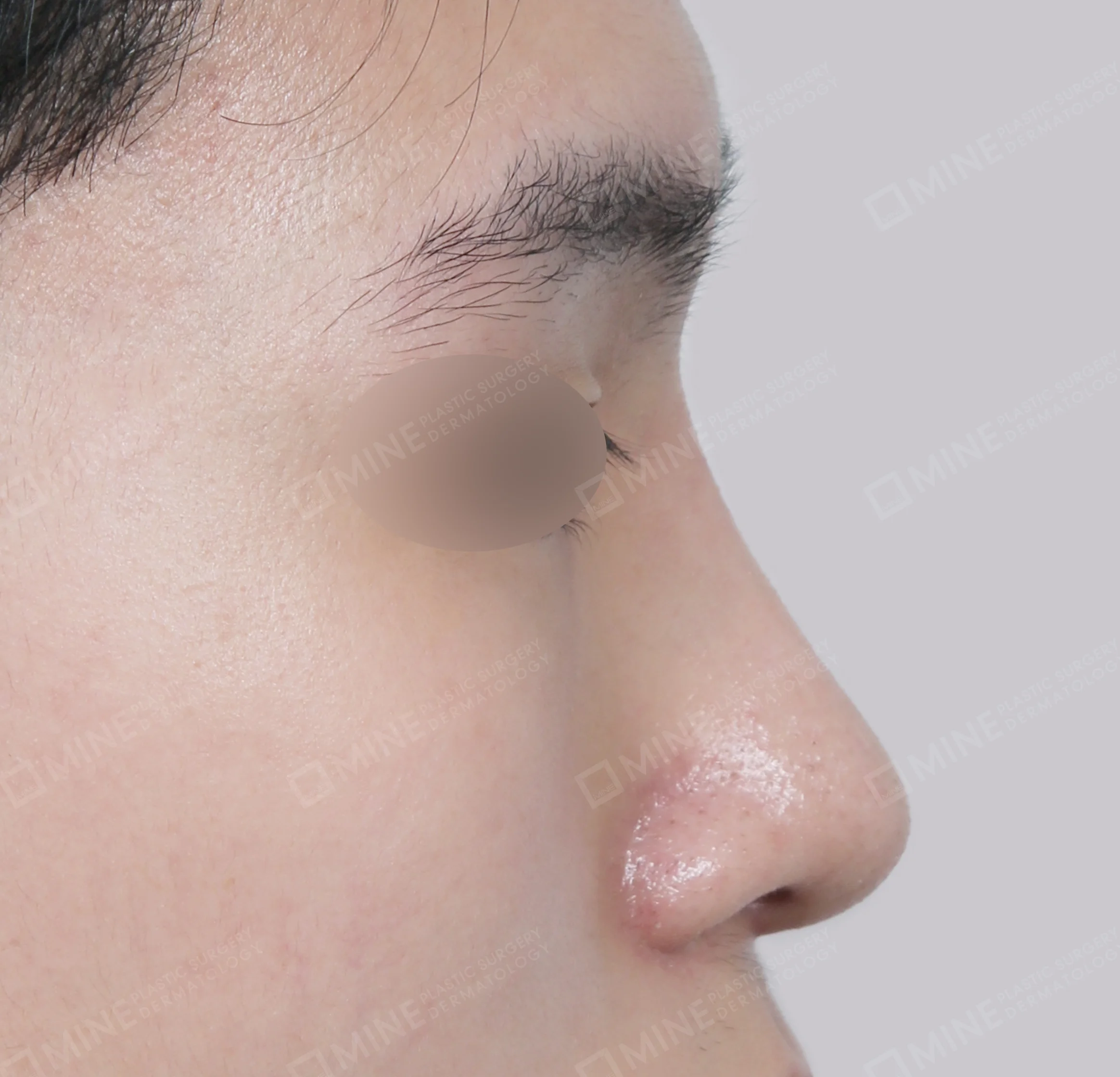 Nâng sống mũi + đầu mũi + kéo dài đầu mũi + thu gọn cánh mũi-측면-후