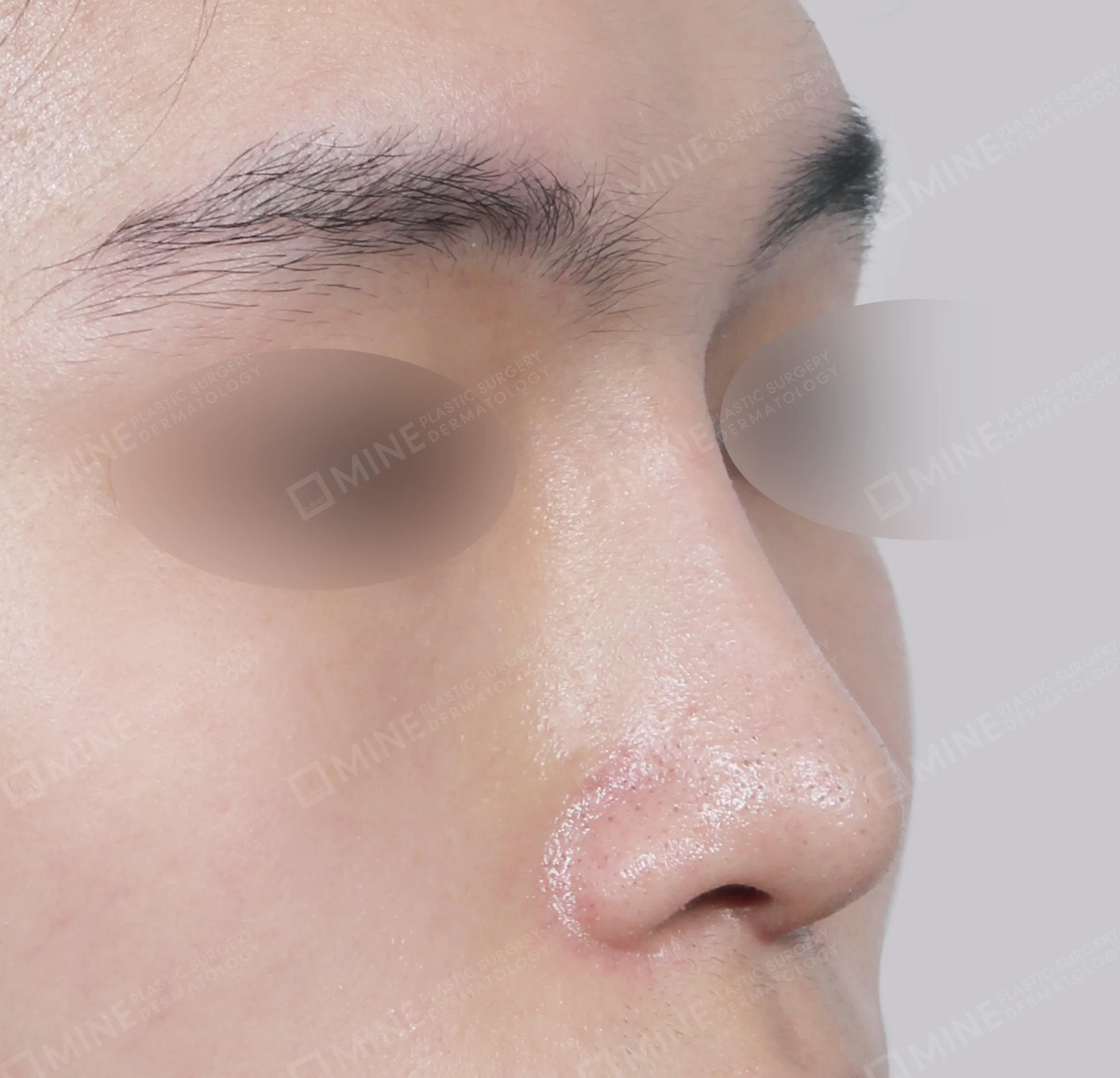 Nâng sống mũi + đầu mũi + kéo dài đầu mũi + thu gọn cánh mũi-45도-후