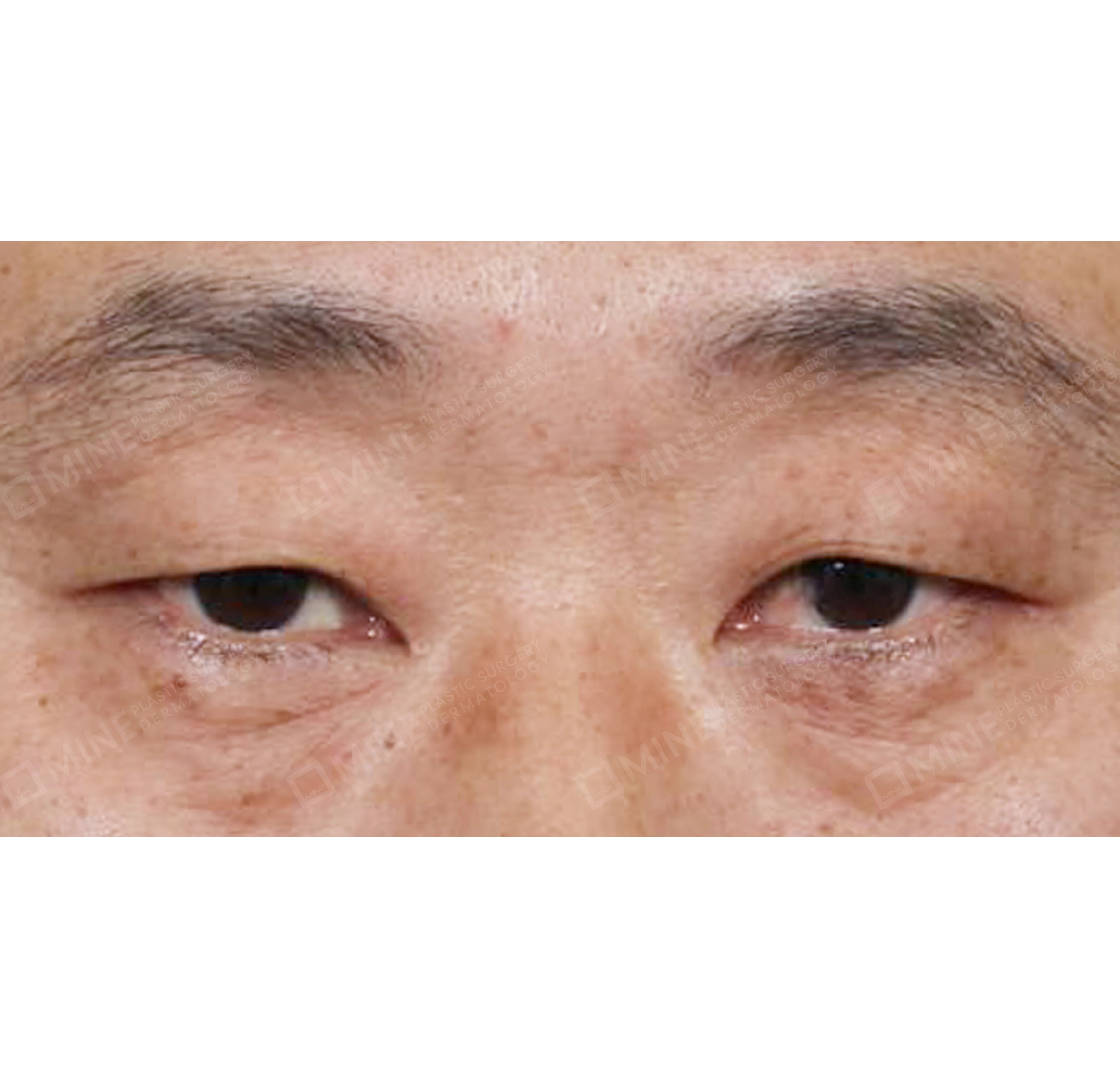 cắt da thừa mí trên-정면-전