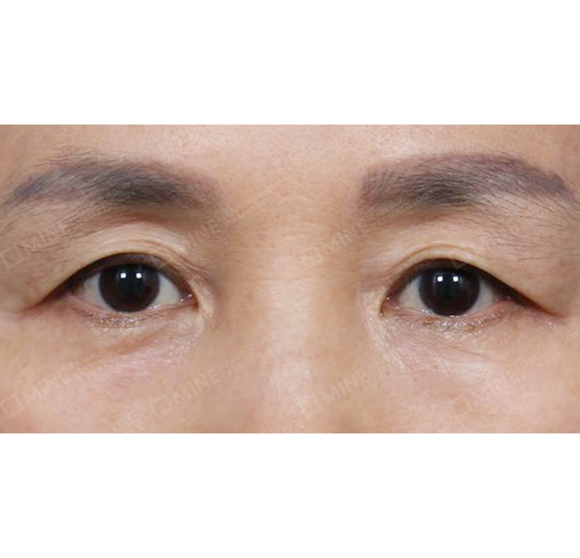 nâng cung mày + cắt da thừa mí trên + cắt da thừa mí dưới-정면-전