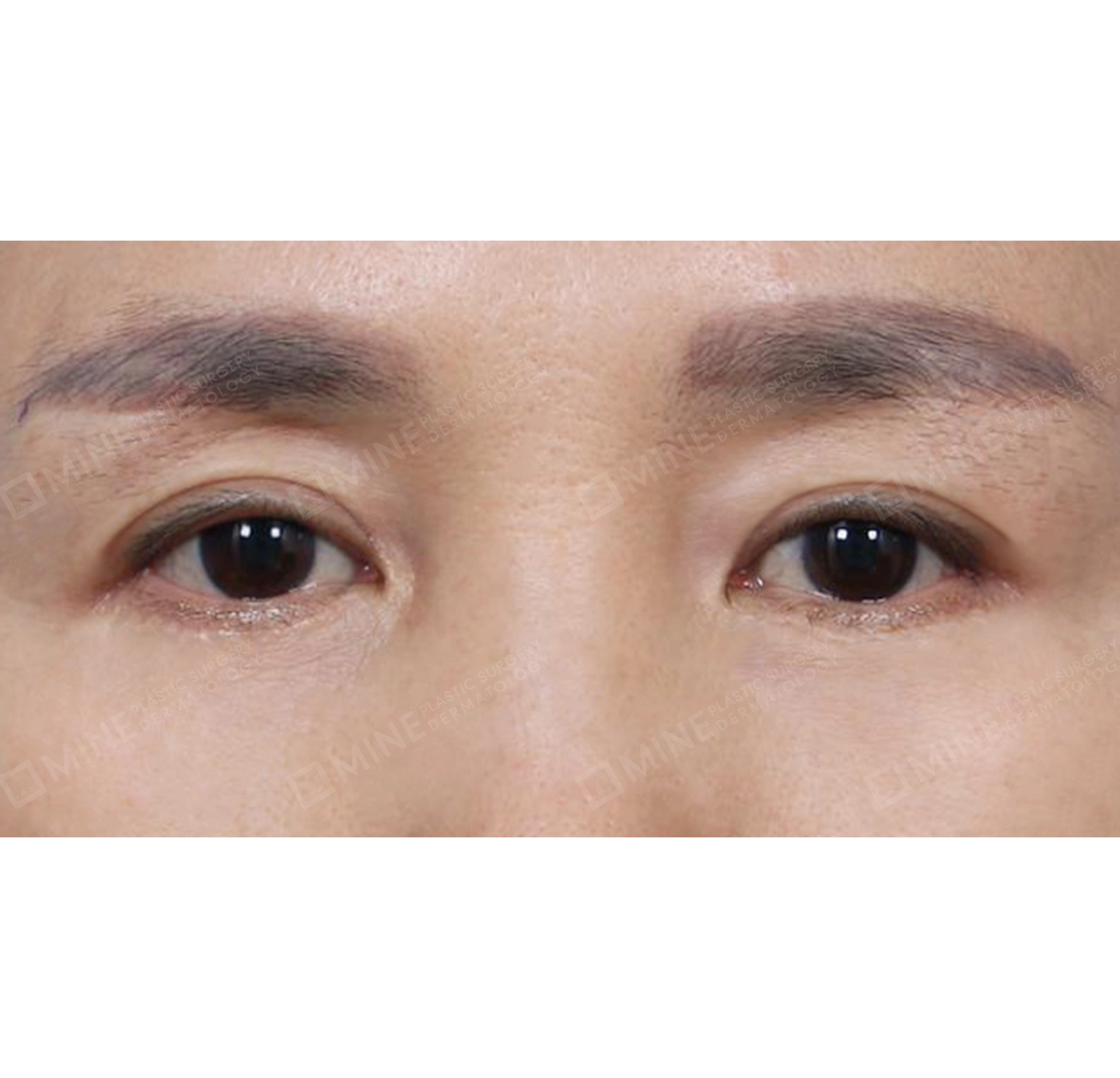 nâng cung mày + cắt da thừa mí trên + cắt da thừa mí dưới-정면-후