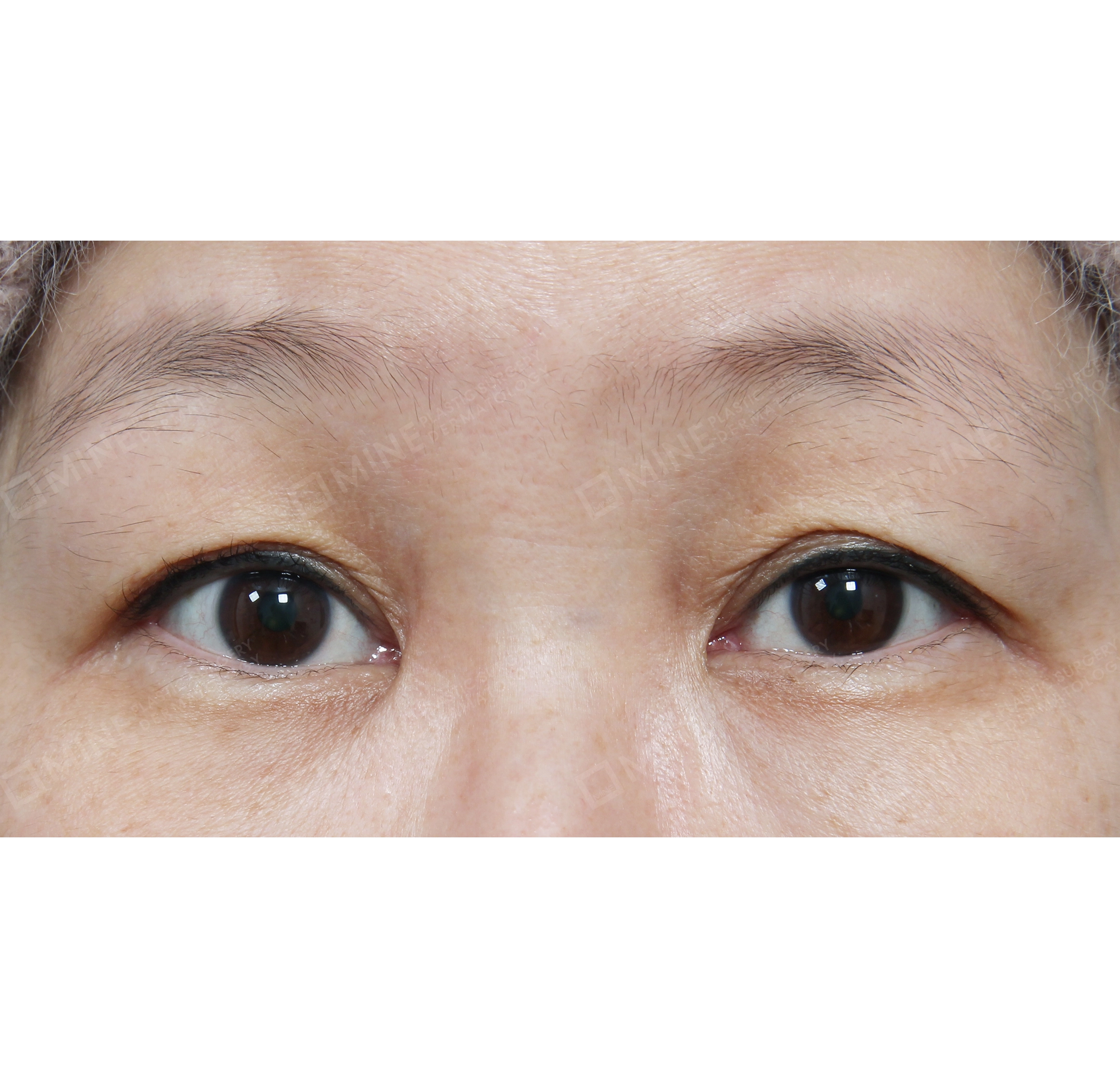 nâng cơ mí + mở góc mắt sau + mở góc mắt dưới-정면-전