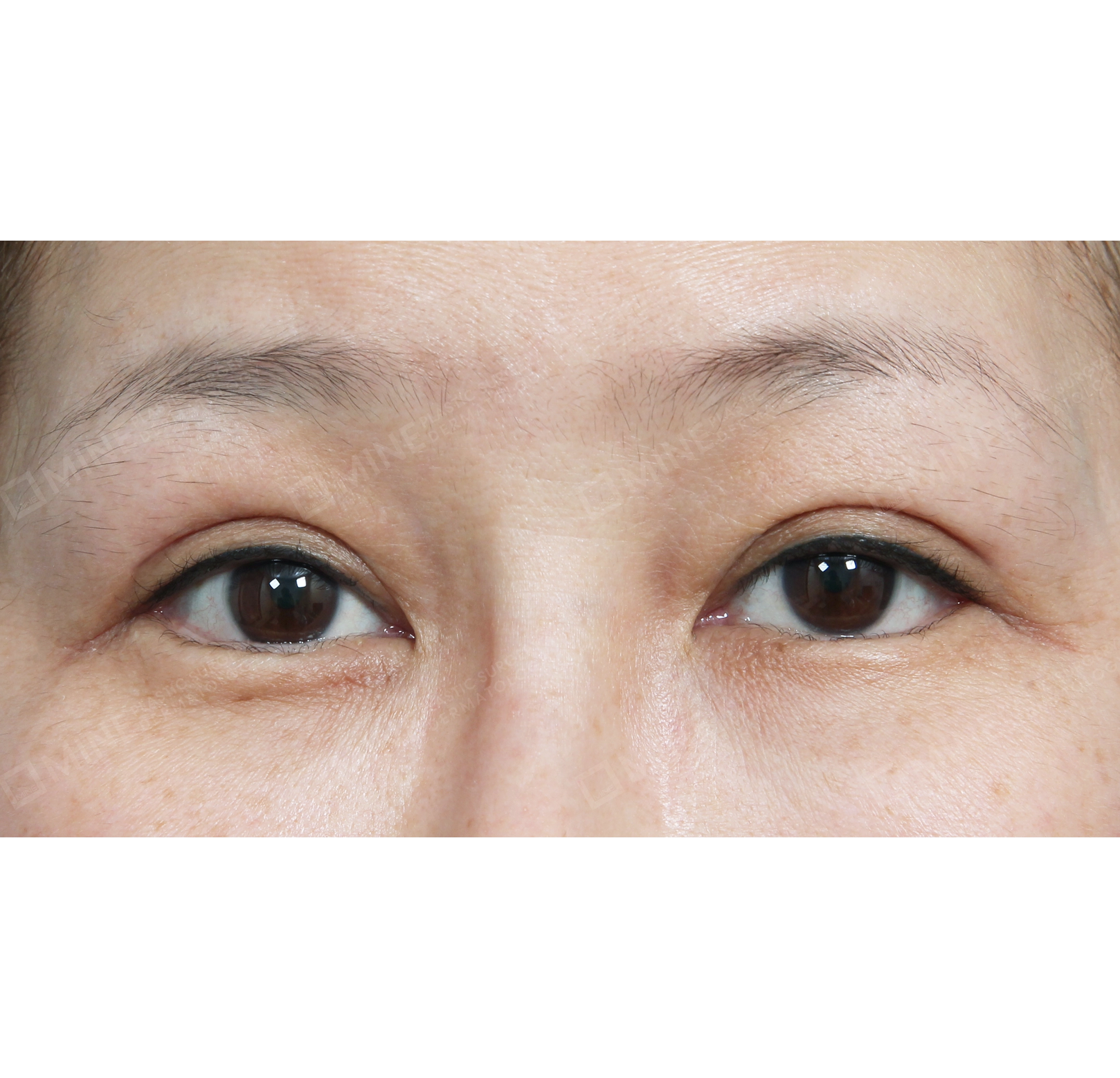 nâng cơ mí + mở góc mắt sau + mở góc mắt dưới-정면-후