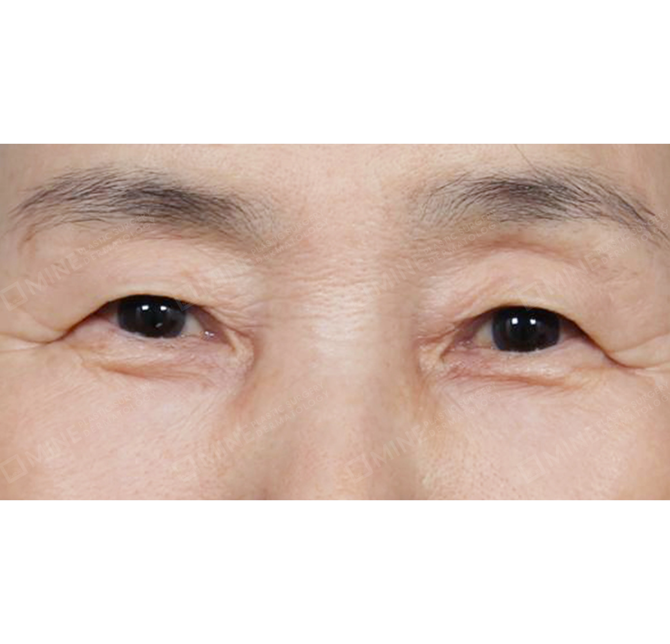 cắt da thừa mí trên + dàn trải mỡ hốc mắt-정면-전