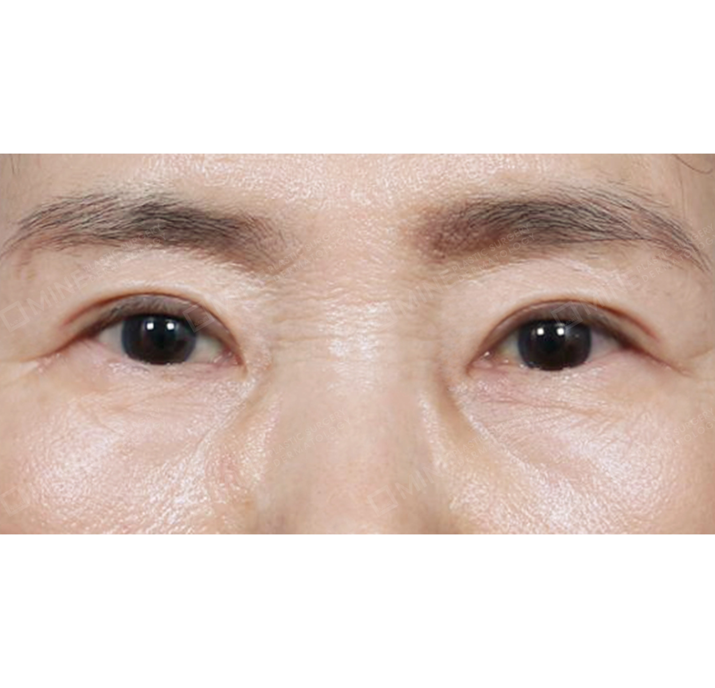 cắt da thừa mí trên + dàn trải mỡ hốc mắt-정면-후