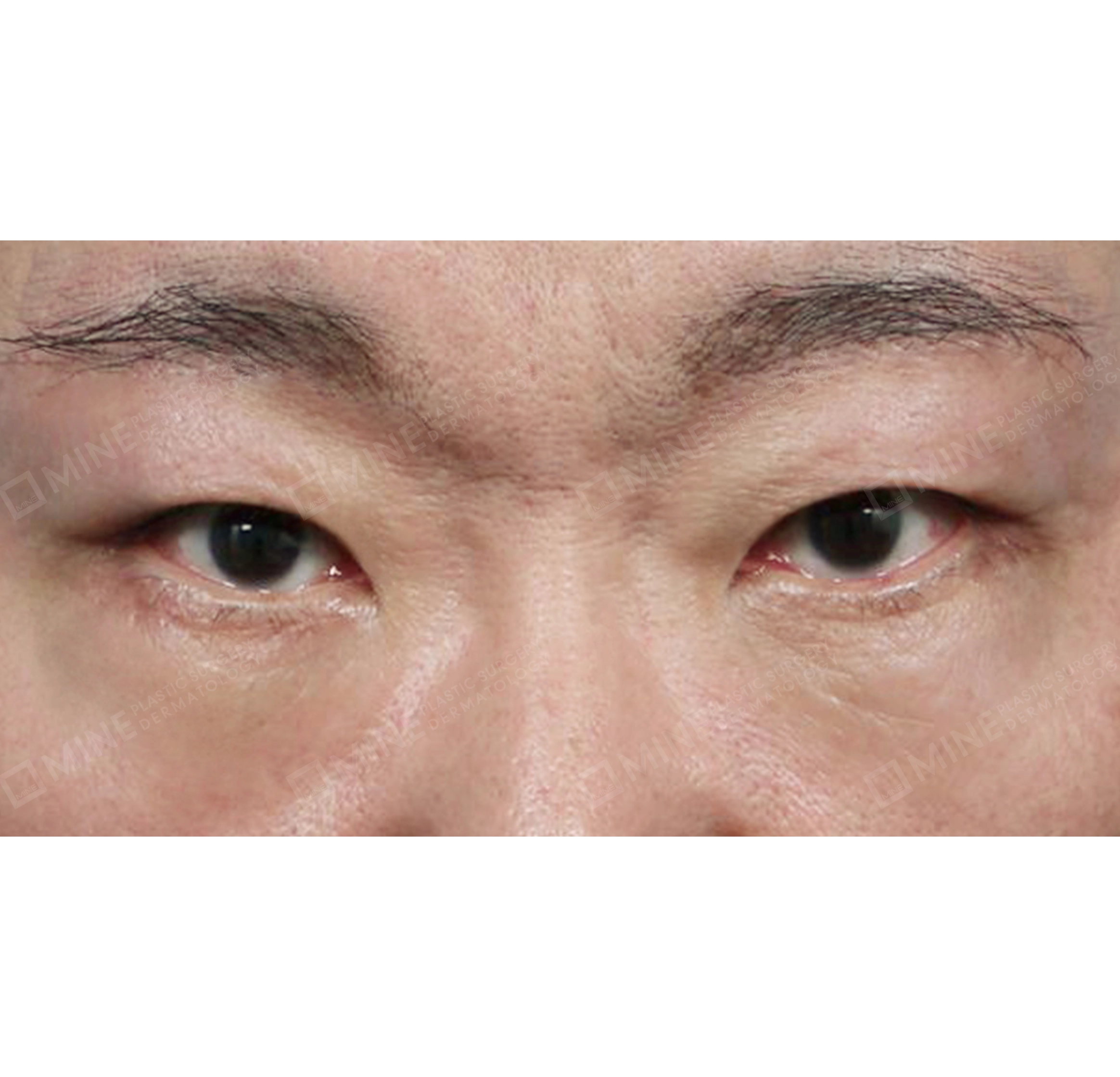 nâng cung mày + cắt da thừa mí dưới + lấy mỡ hốc mắt-정면-후