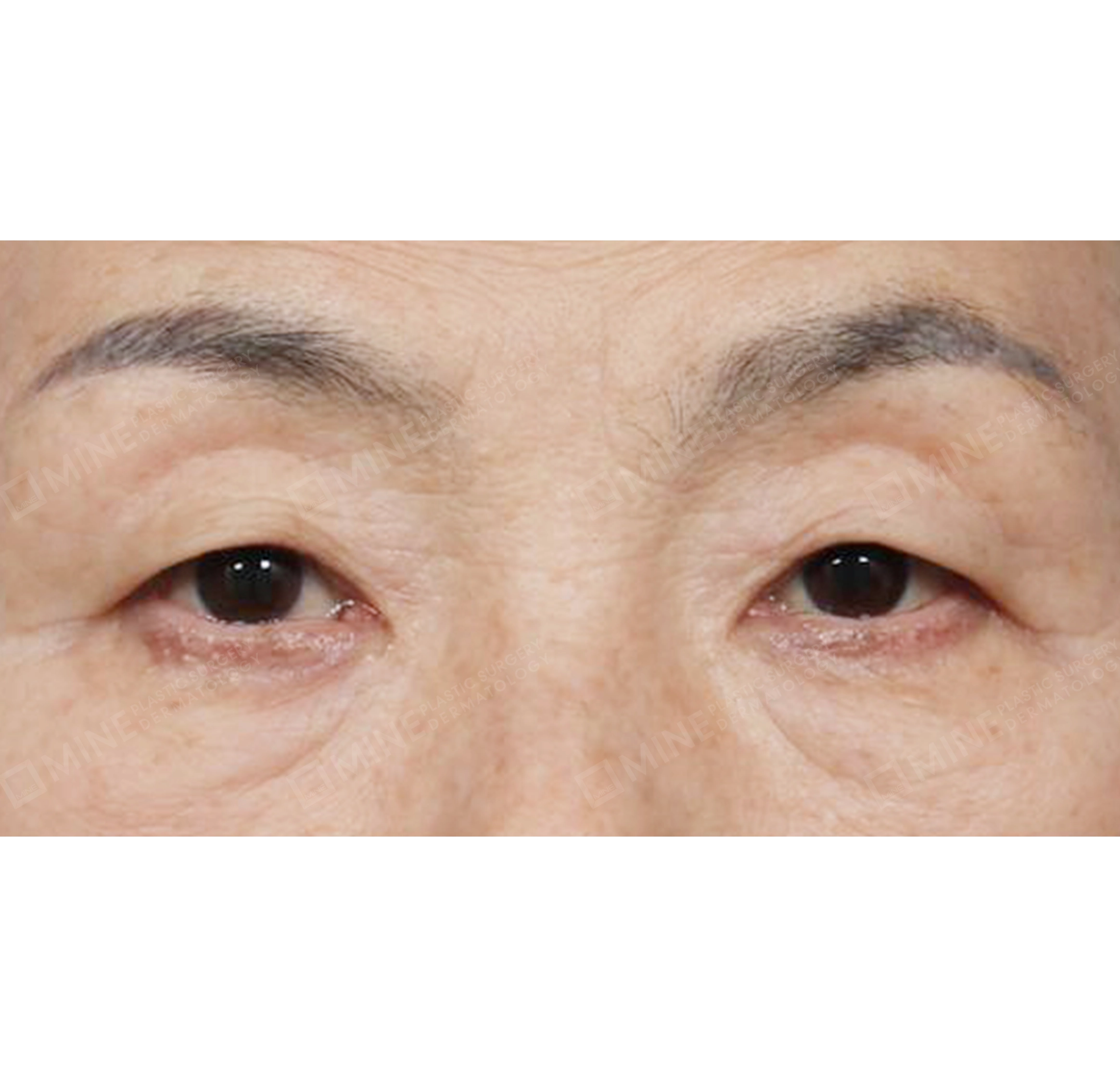 nâng cung mày + cắt da thừa mí trên + cắt da thừa mí dưới-정면-전