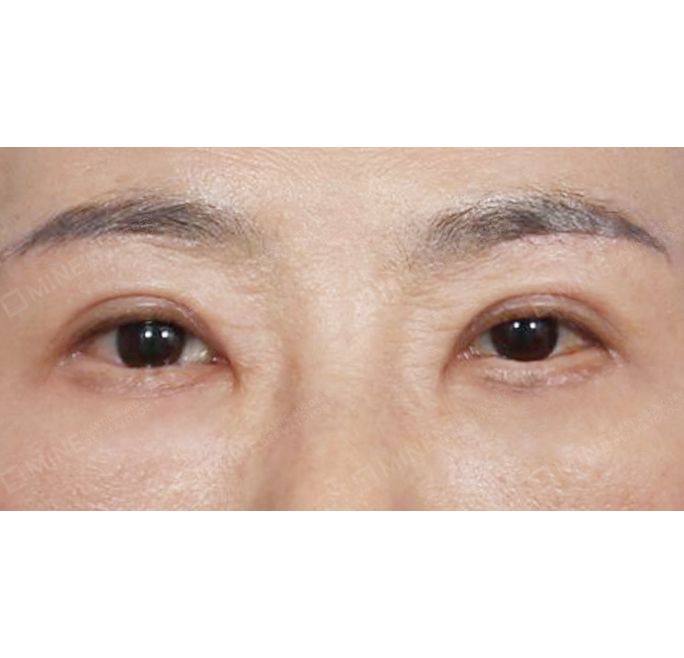 nâng cung mày + cắt da thừa mí trên + cắt da thừa mí dưới-정면-후