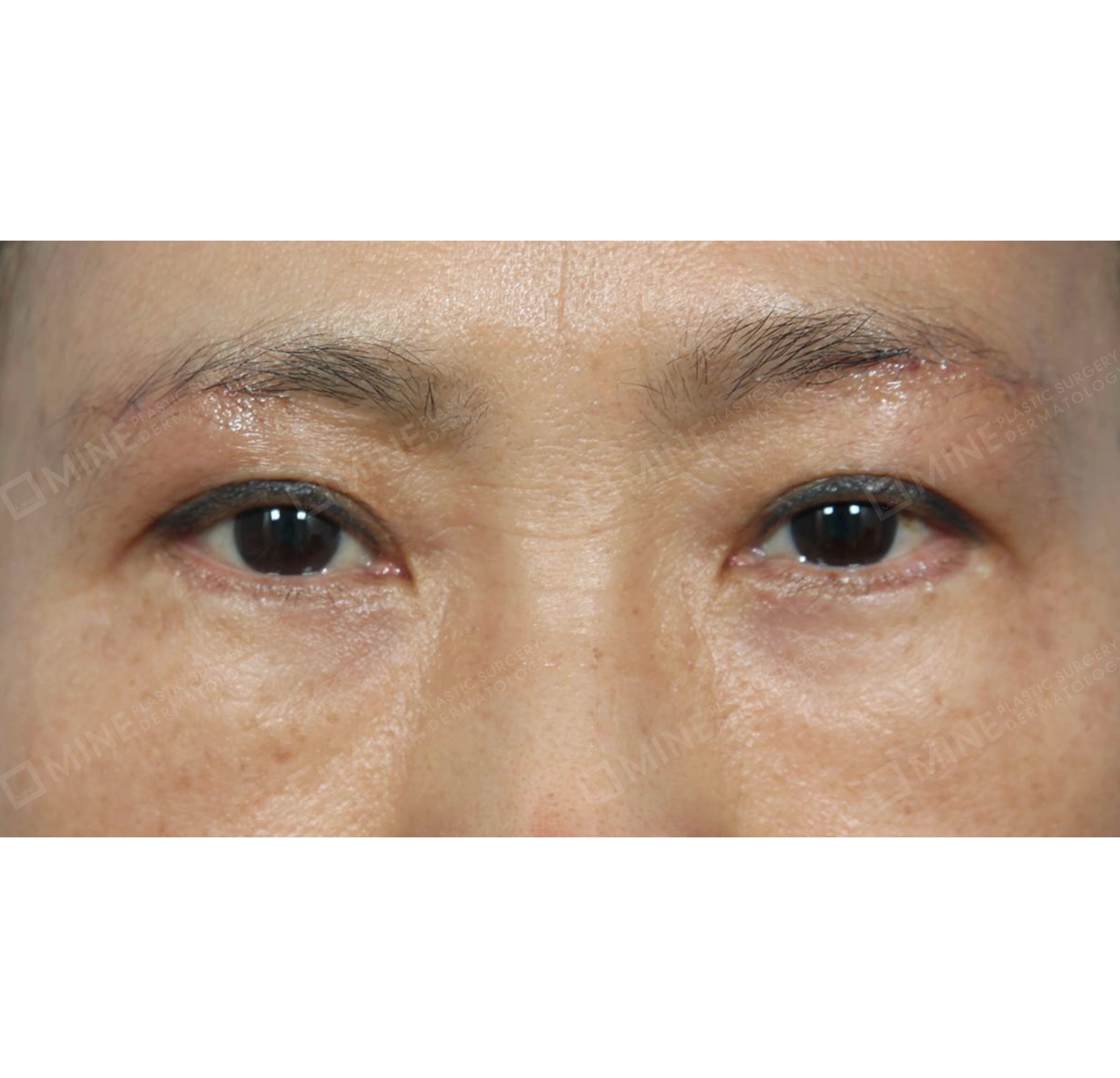 nâng cung mày + cắt mí nâng cơ-정면-후