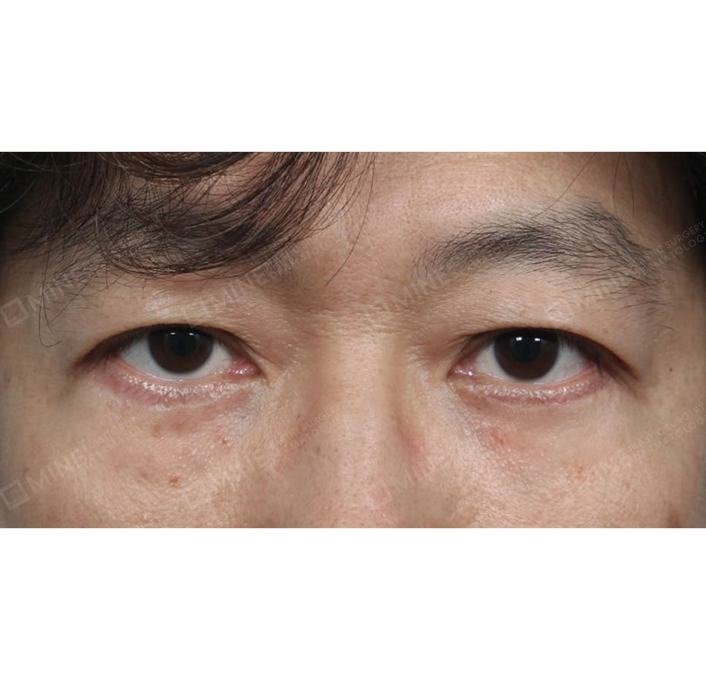 dàn trải bọng mỡ mí dưới-정면-후