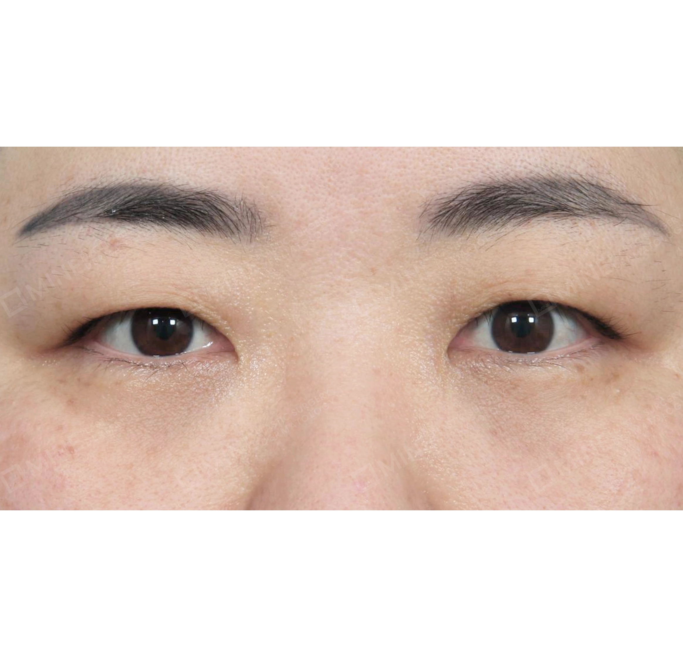 cắt mí nâng cơ-정면-전