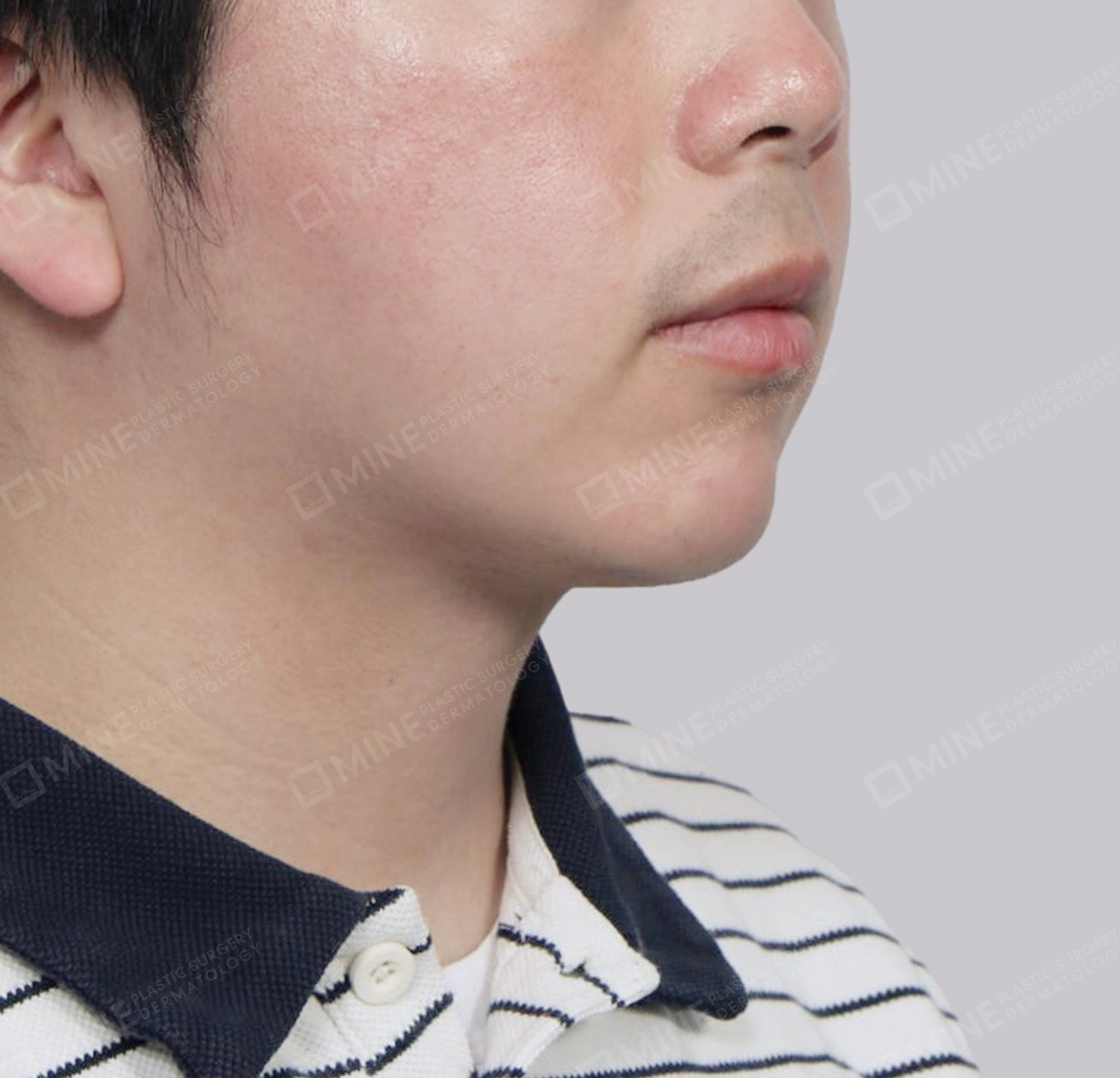 Hút mỡ nọng buộc cơ-정면-후