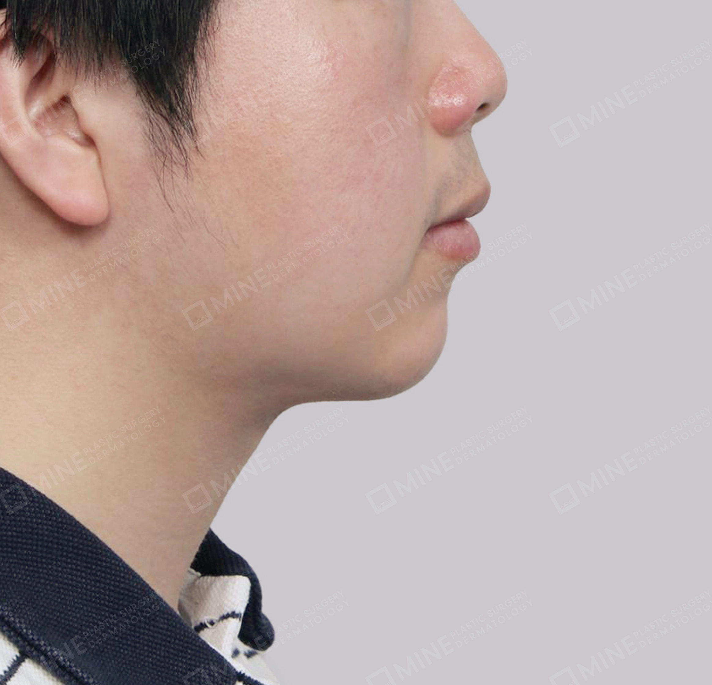 Hút mỡ nọng buộc cơ-측면-후