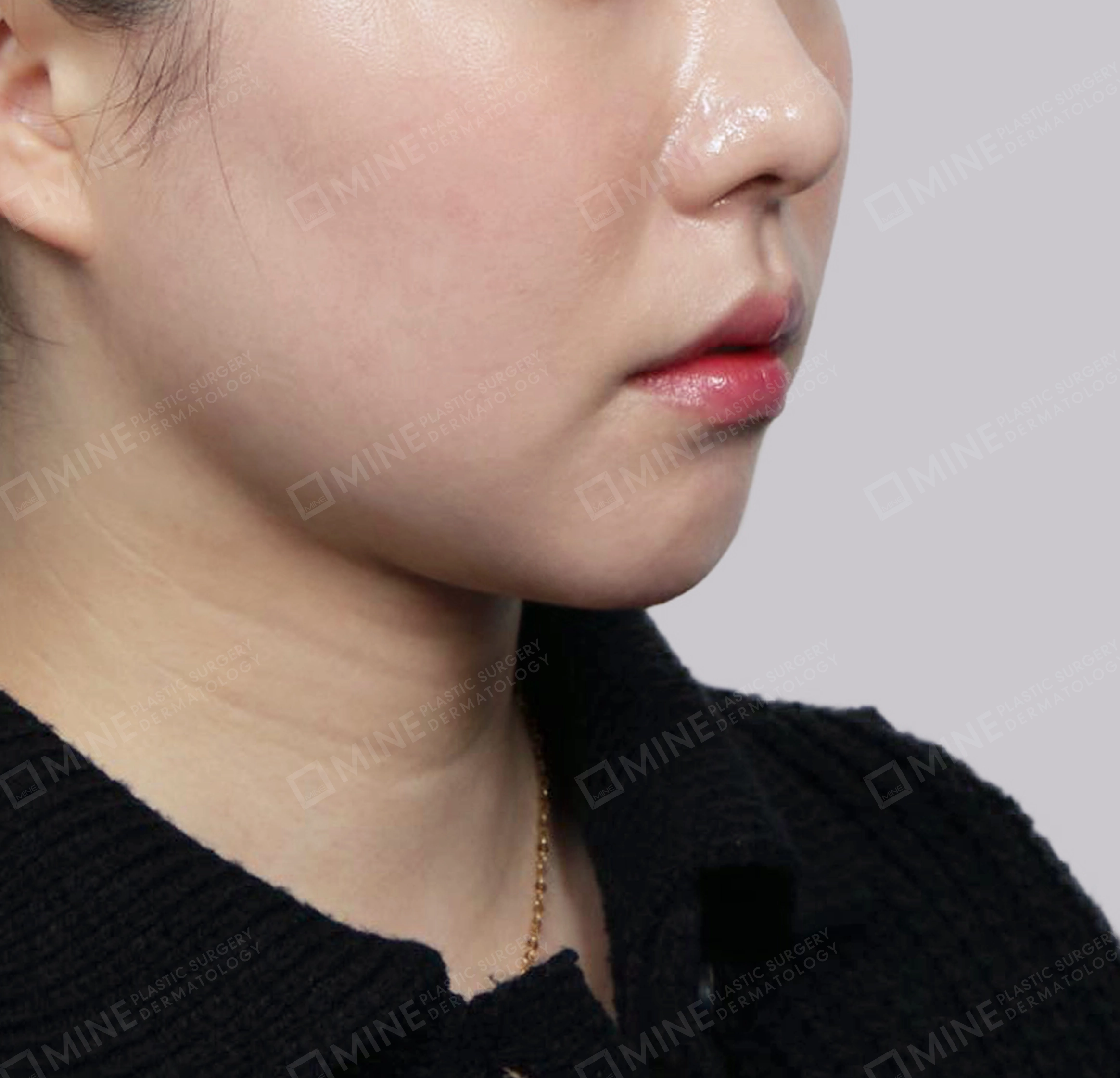 Hút mỡ nọng buộc cơ-정면-후