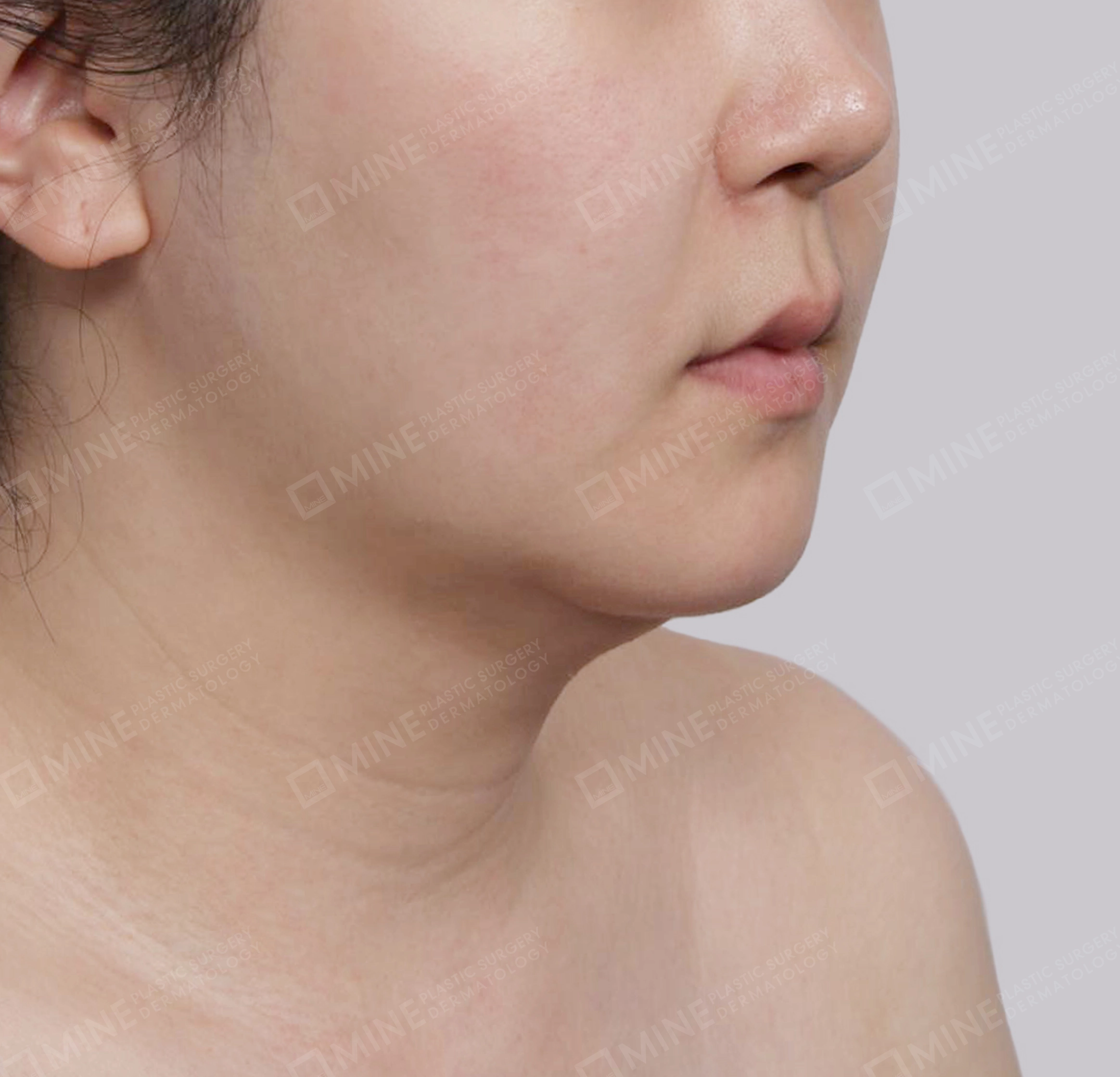 Căng da cổ Mini-정면-전