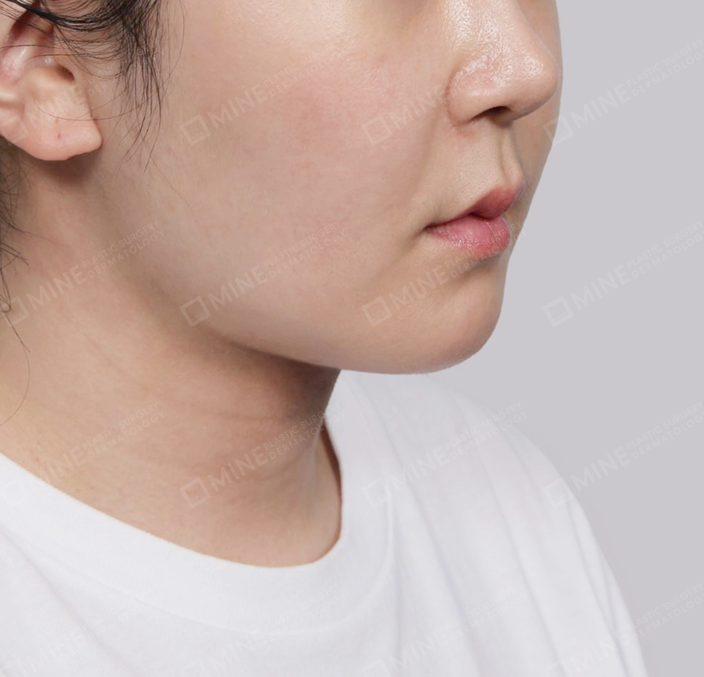 Căng da cổ Mini-정면-후