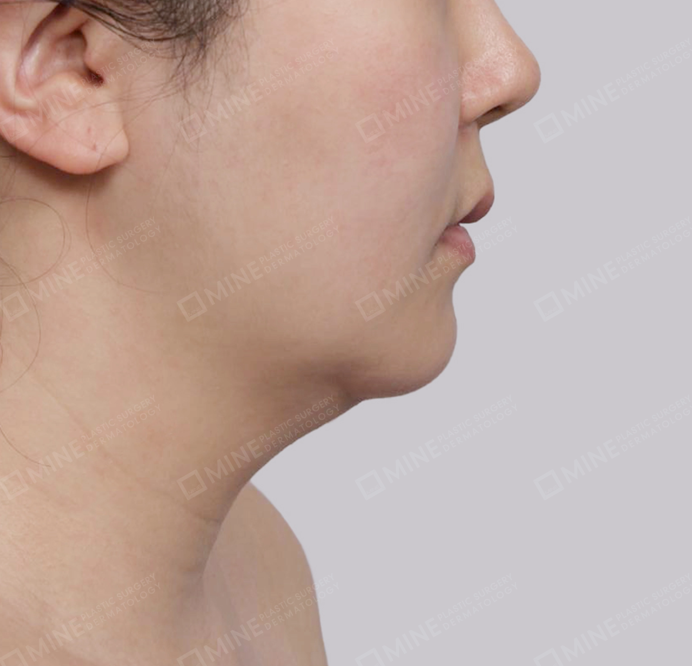 Căng da cổ Mini-측면-전