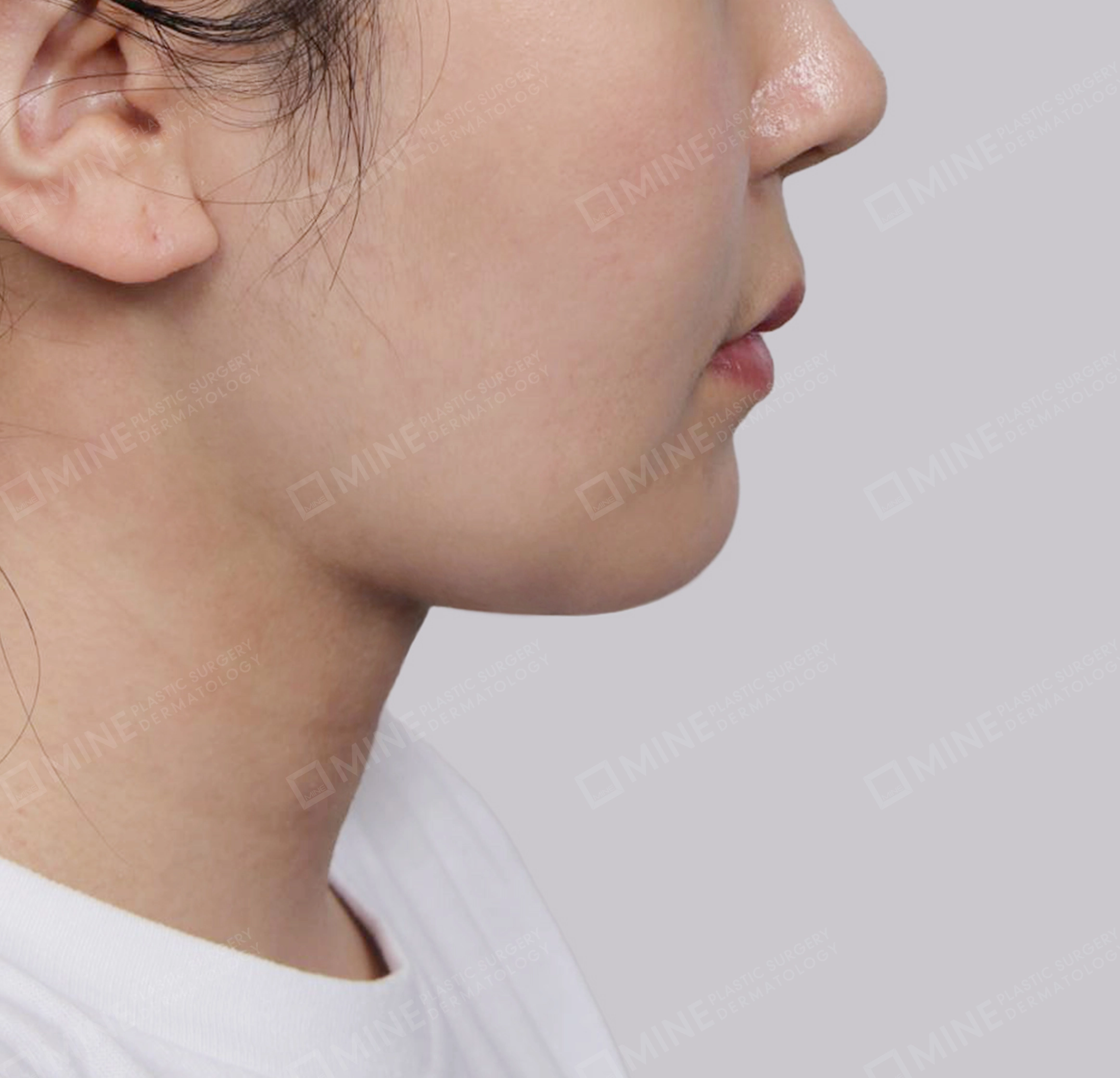 Căng da cổ Mini-측면-후