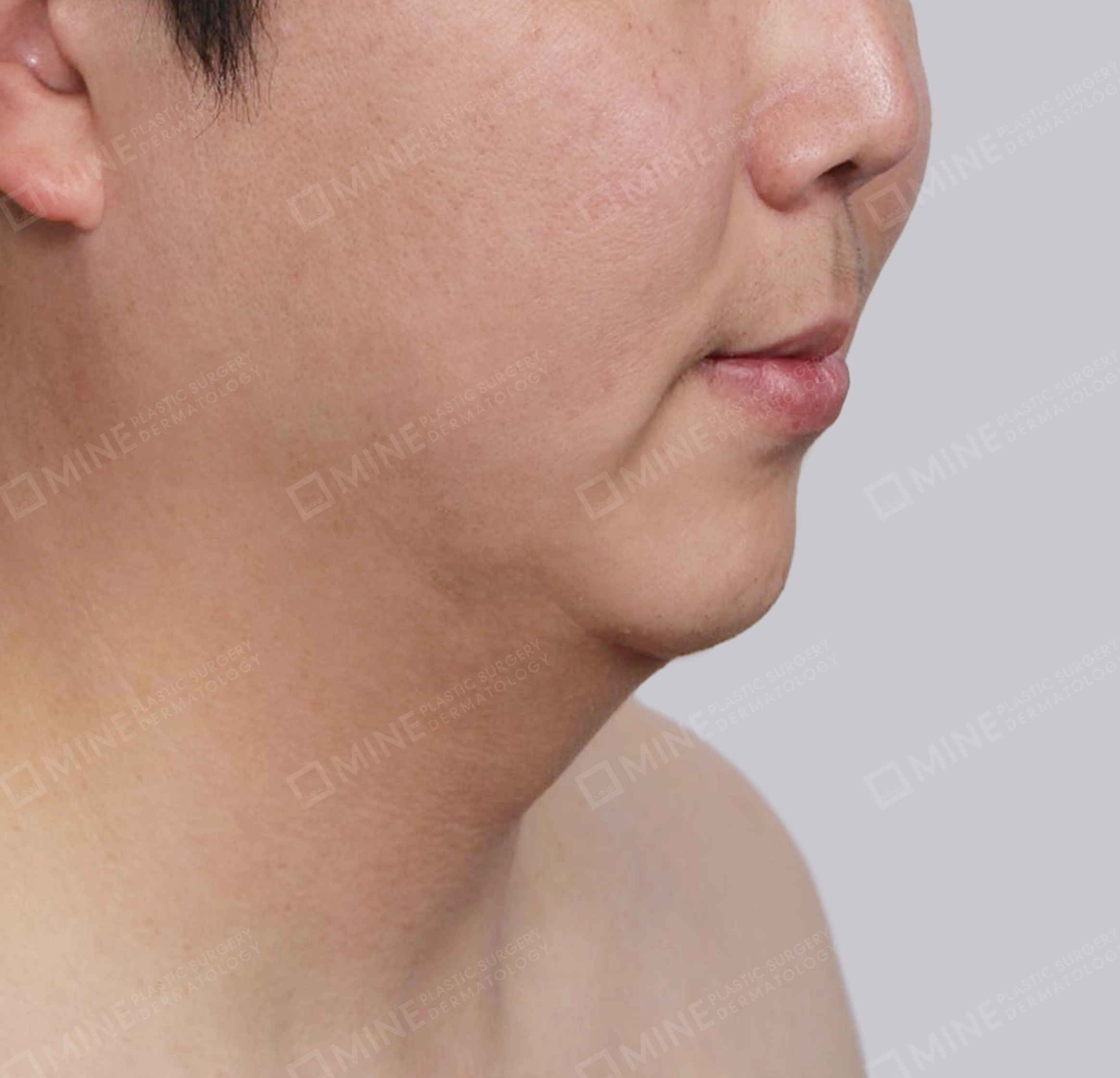 Căng da cổ Mini-정면-전