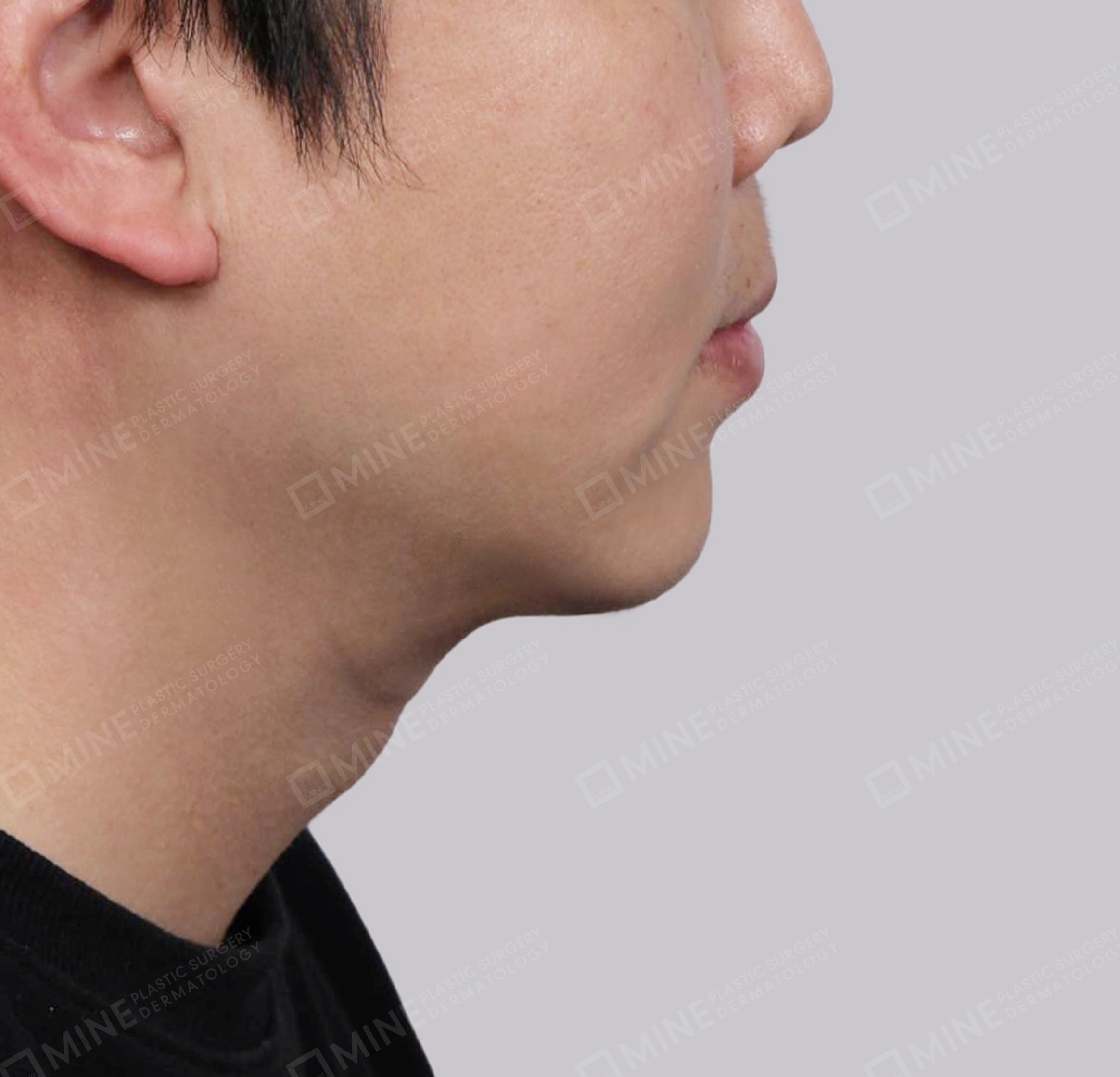 Căng da cổ Mini-측면-후