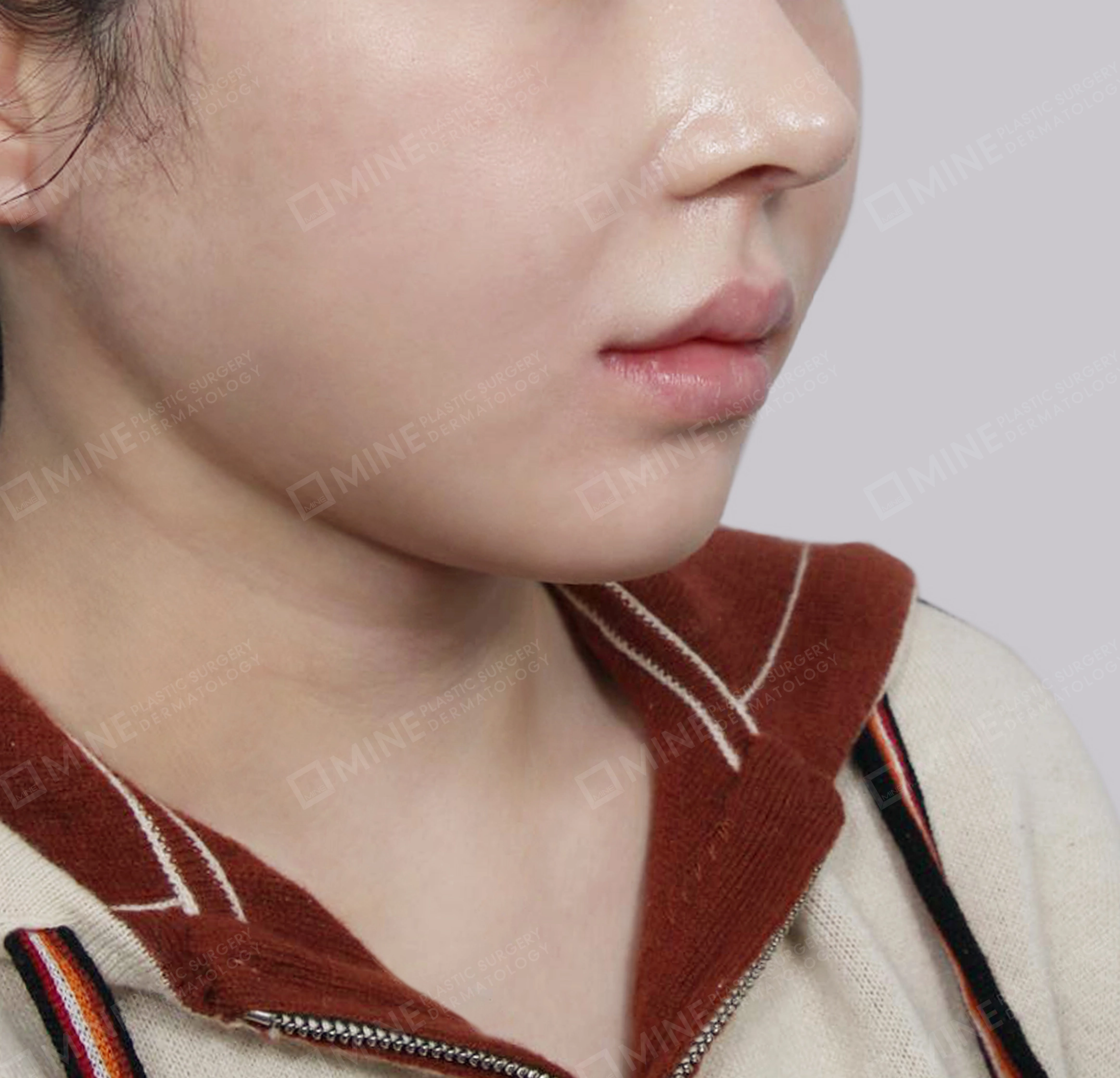 Căng da cổ Mini-정면-후