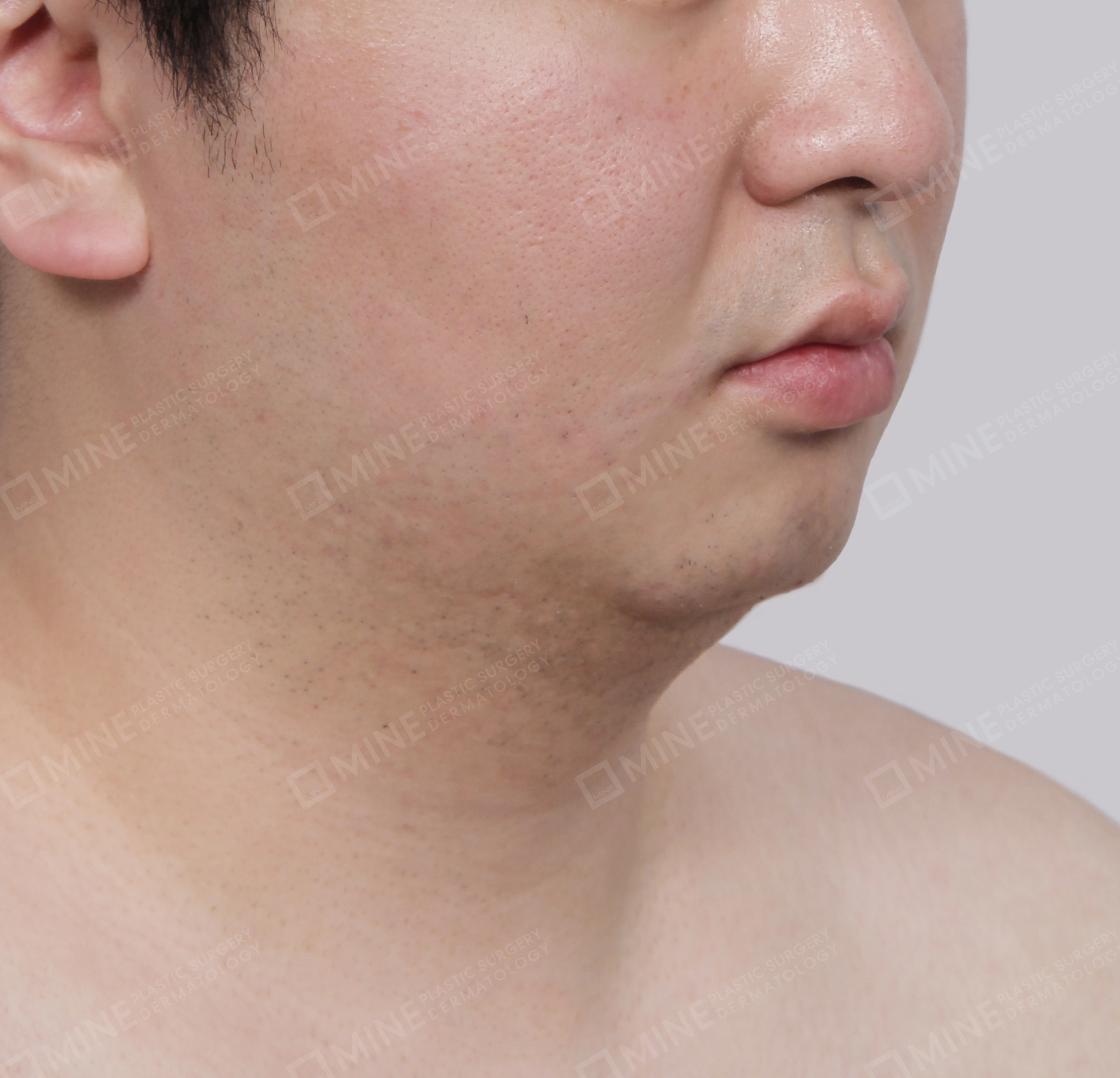 Căng da cổ Mini-정면-전