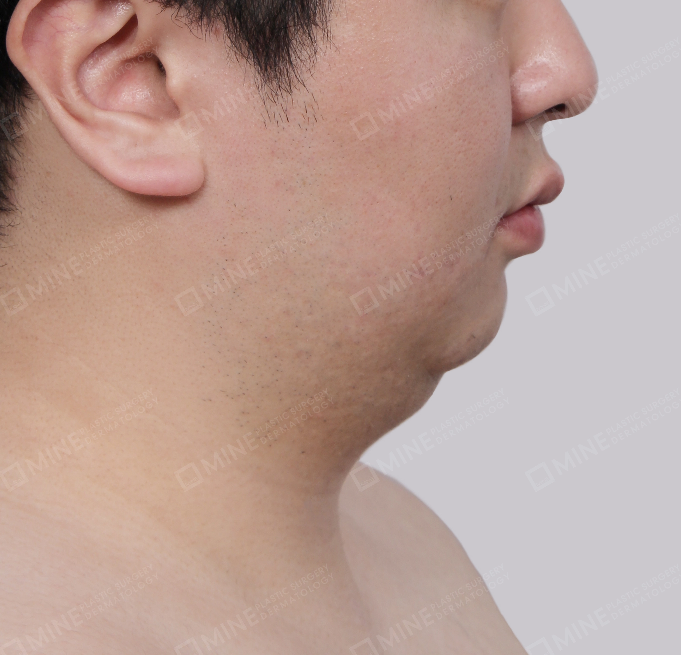 Căng da cổ Mini-측면-전