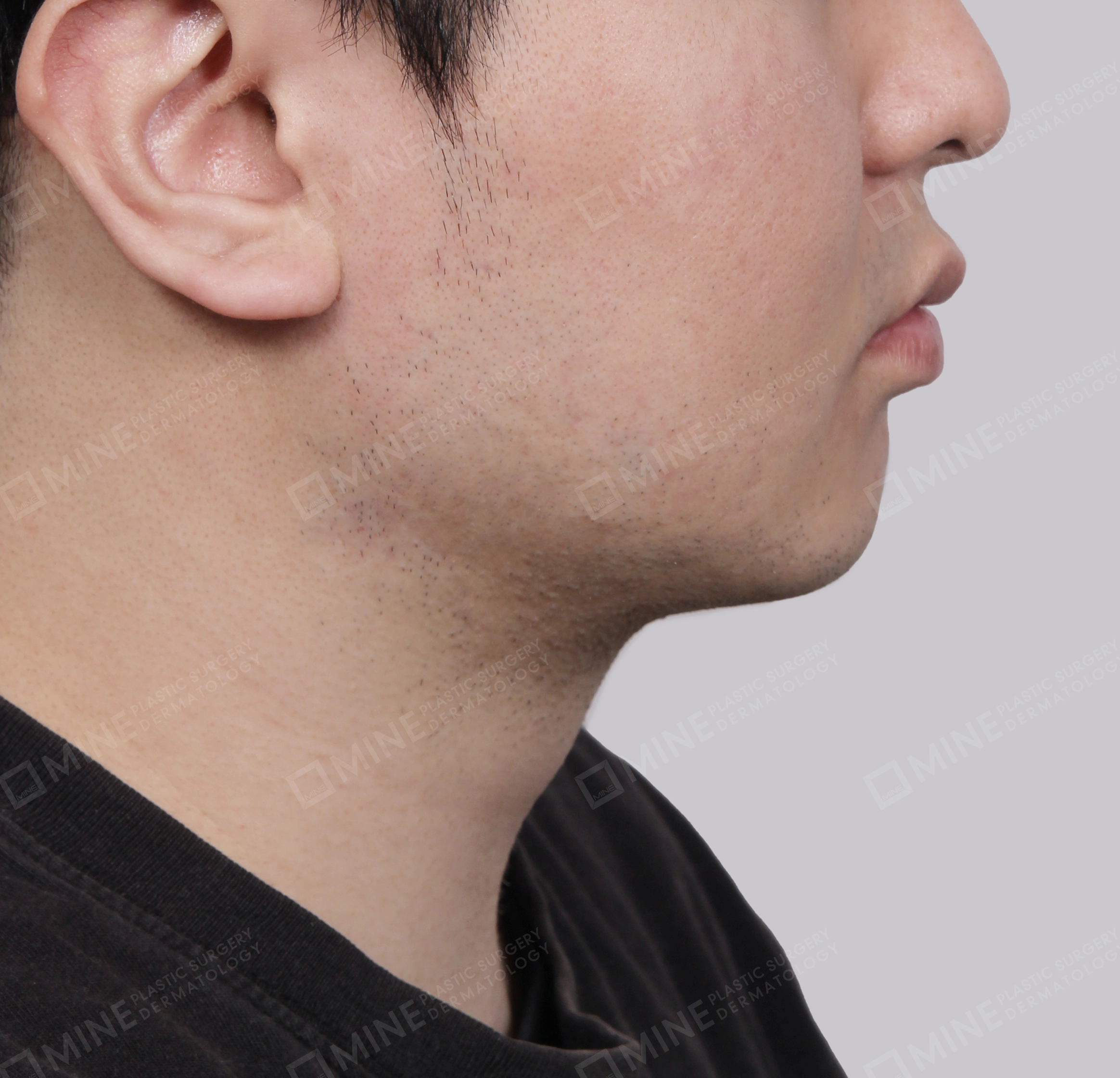 Căng da cổ Mini-측면-후