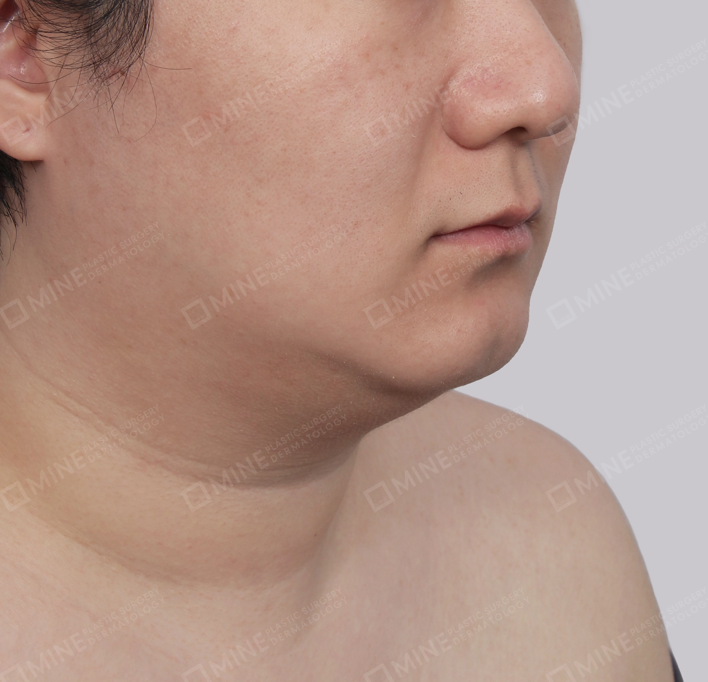 Căng da cổ Mini-정면-전