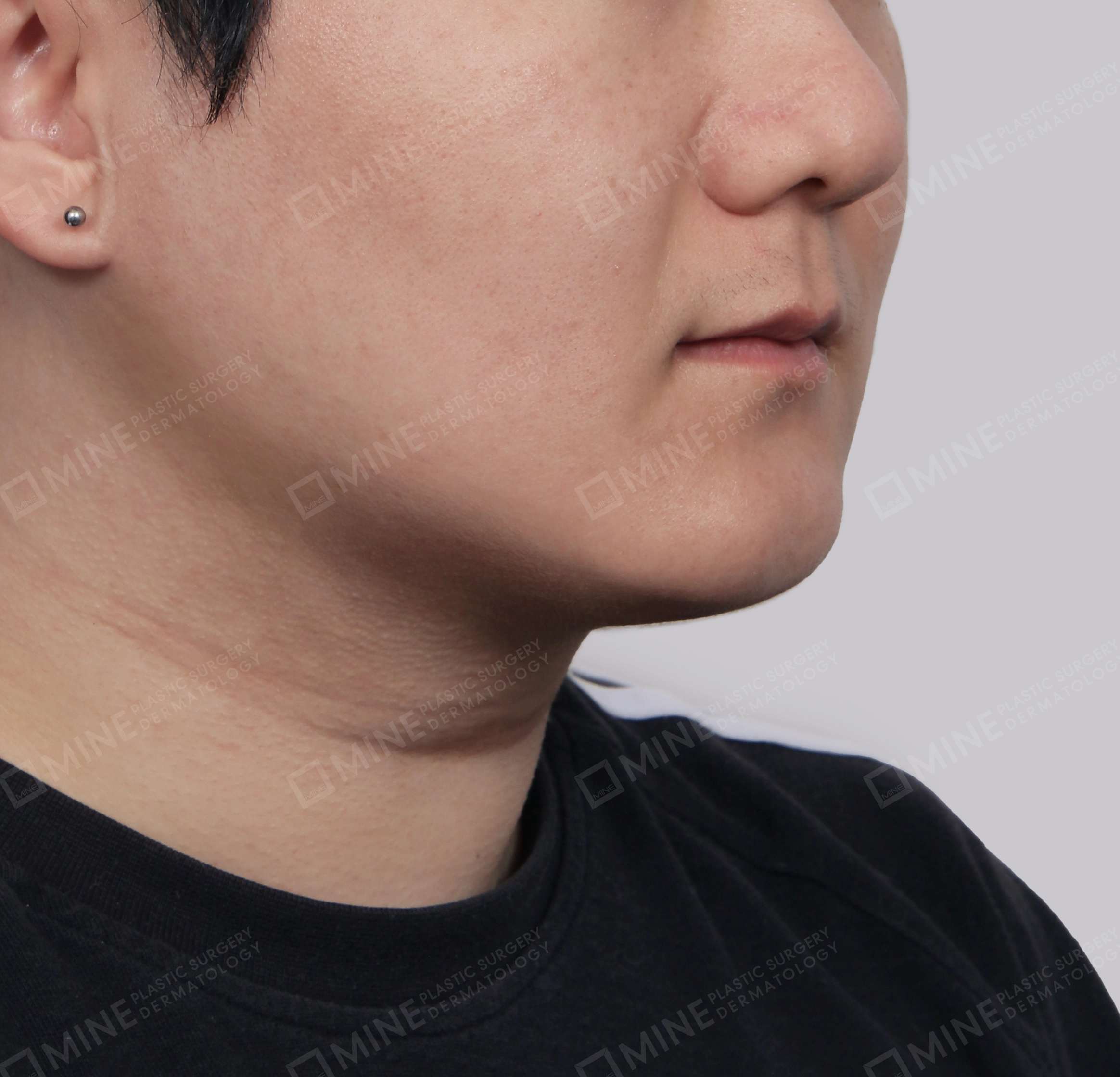 Căng da cổ Mini-정면-후