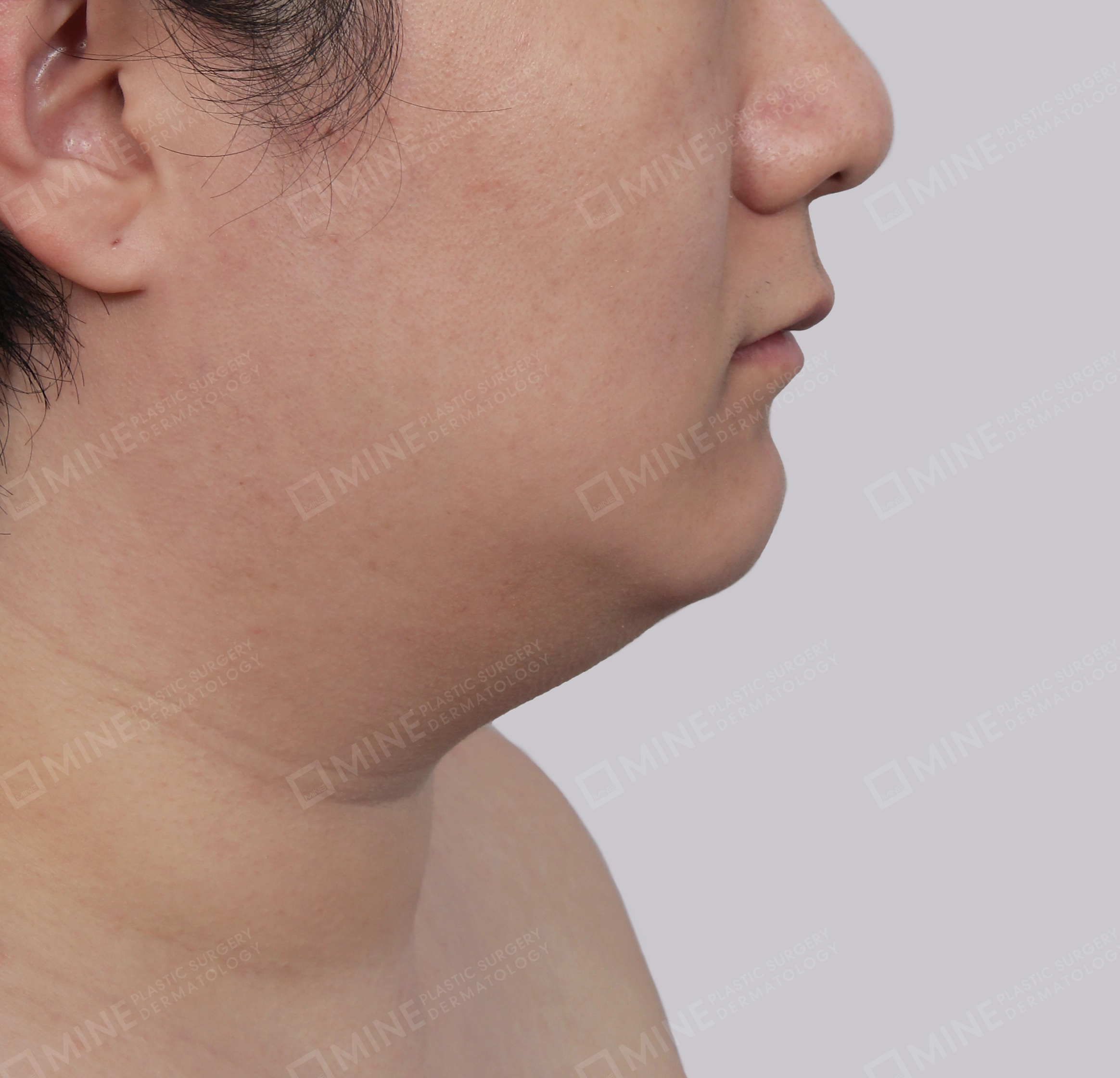 Căng da cổ Mini-측면-전