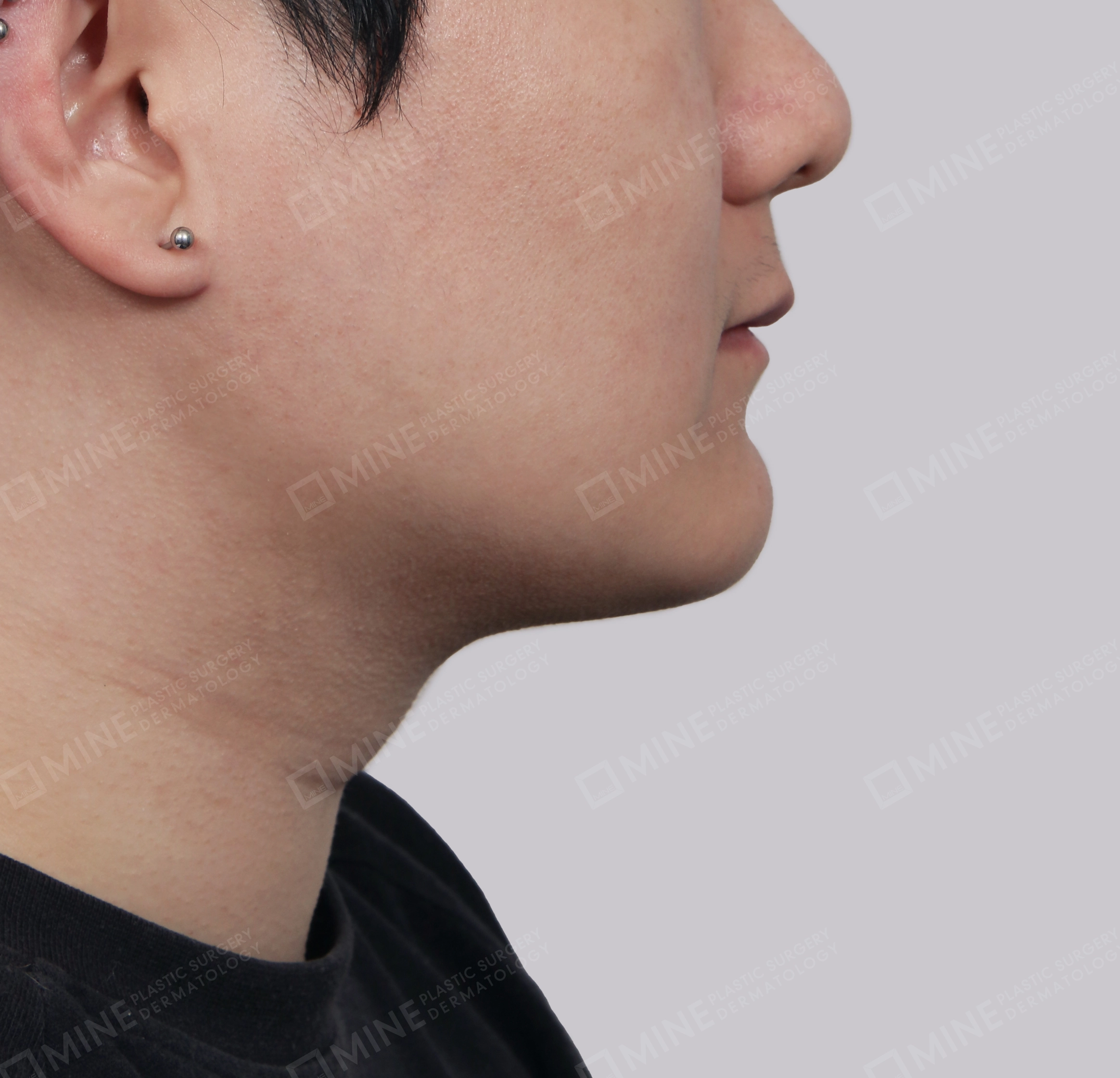 Căng da cổ Mini-측면-후